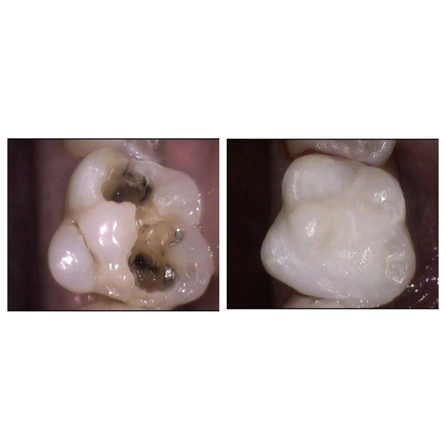 Composite filling restoration