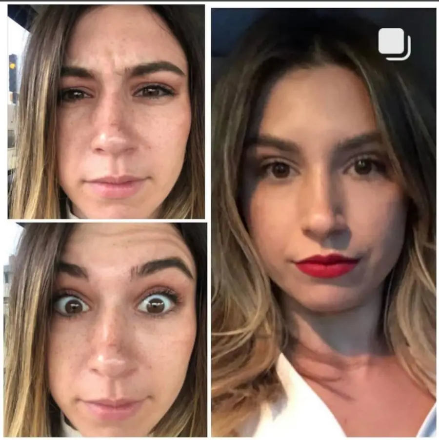 Before and after results of Botox treatment for frown lines at Loukas Dentistry in Park Ridge, IL