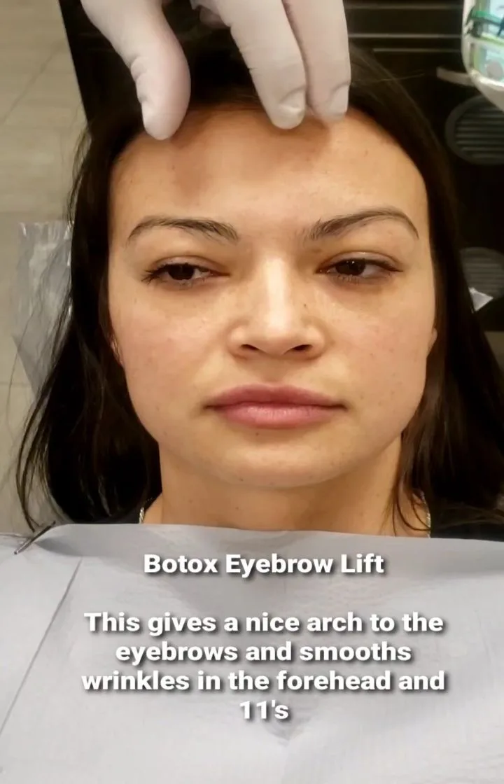 Before and after Botox raising the eyebrows and smoothing forehead lines, Loukas Dentistry of Park Ridge, Illinois