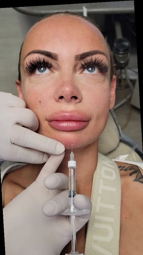 Examples of Botox, lip filler and chin filler treatment results, Loukas Dentistry of Park Ridge, Illinois
