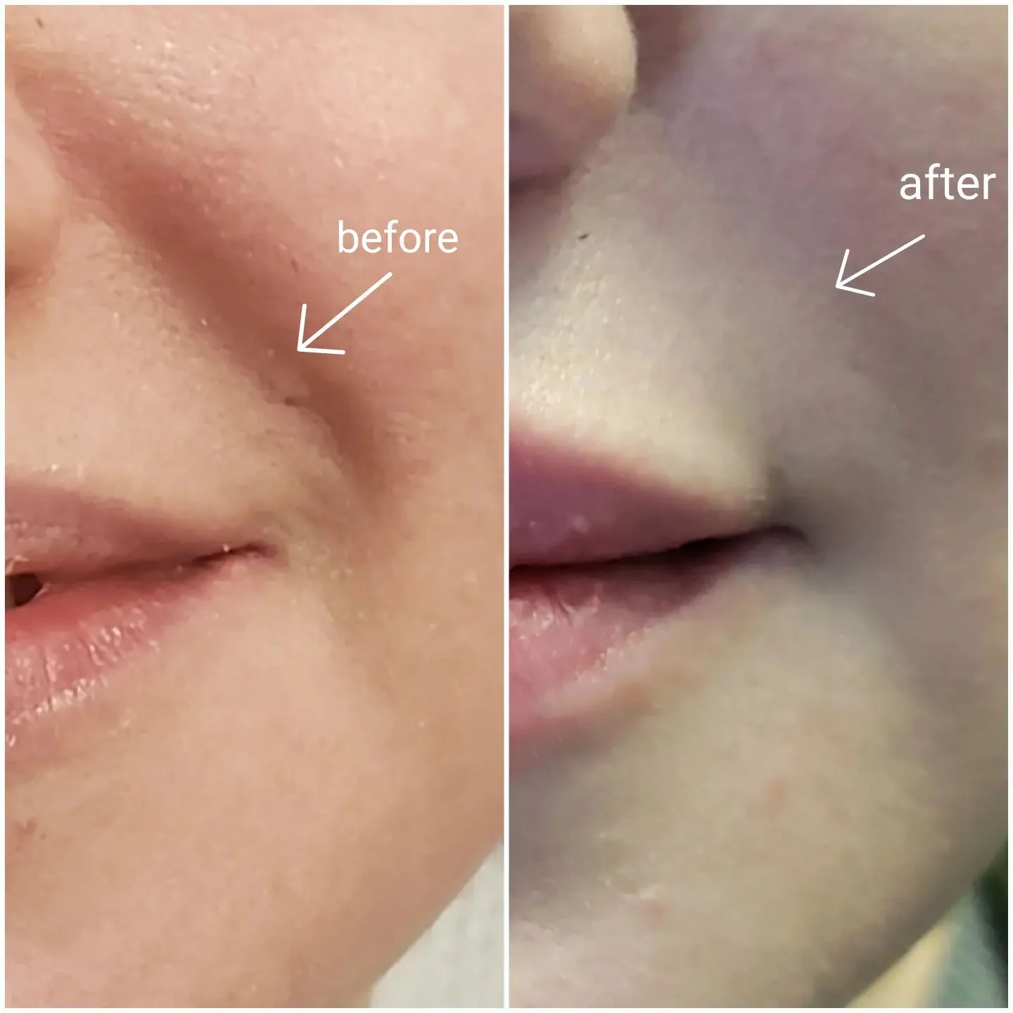 Before and after dermal filler softening the smile lines beside the mouth, Loukas Dentistry of Park Ridge, Illinois