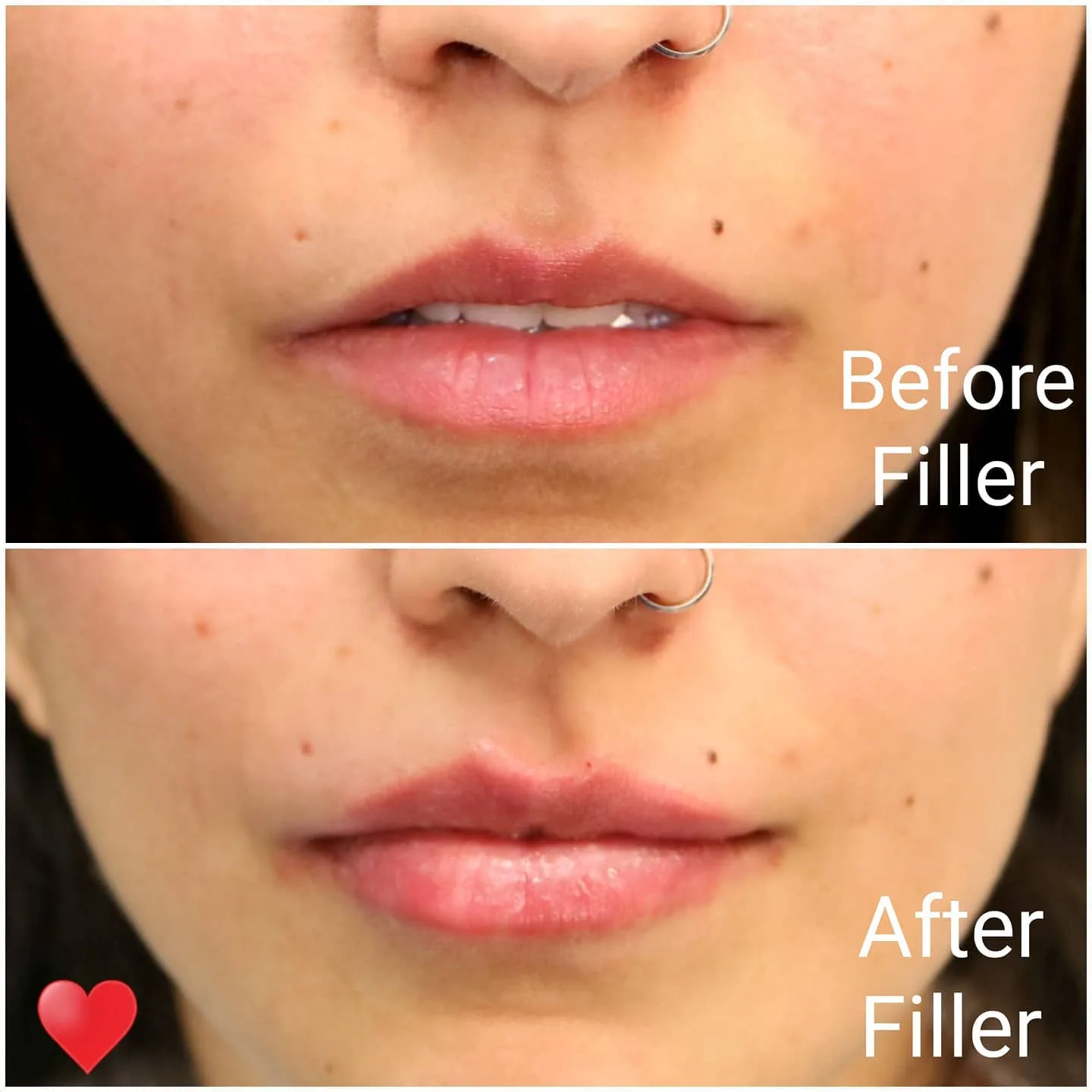 Before and after dermal filler defining the chin and jawline, Loukas Dentistry of Park Ridge, Illinois
