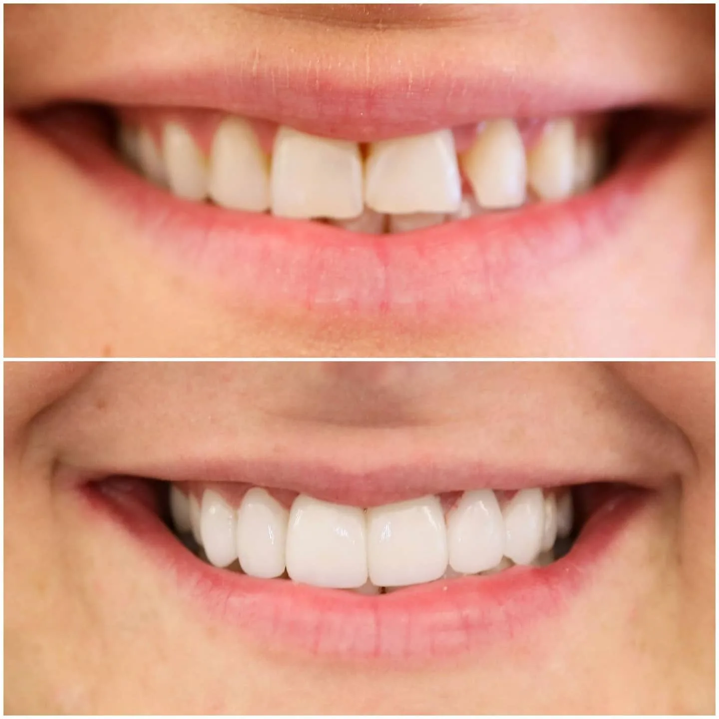 Before and after cosmetic dentistry evening out chipped and crowded upper front teeth, Loukas Dentistry of Park Ridge, Illinois