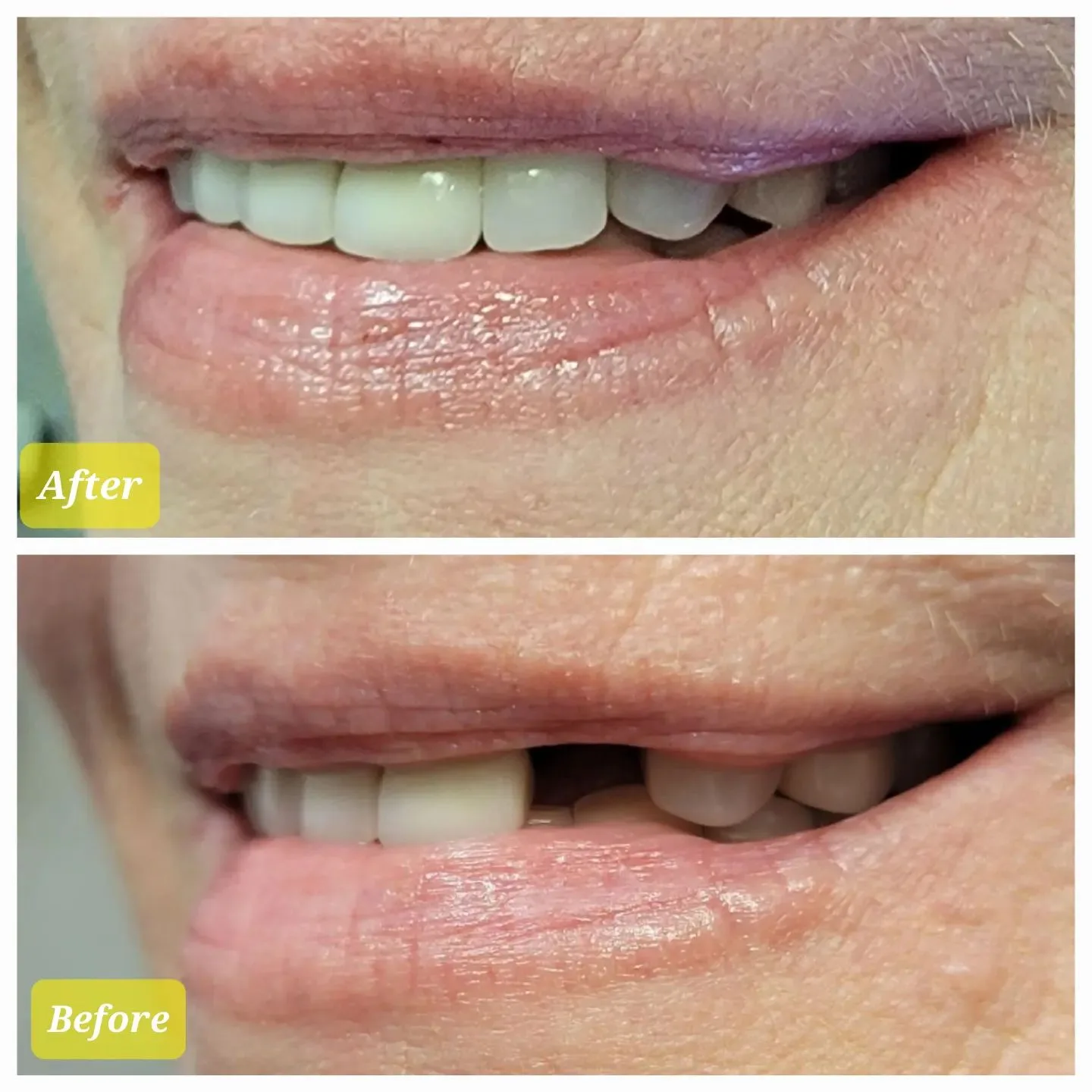 Before and after dental implant crowns replacing missing and worn upper teeth, Loukas Dentistry of Park Ridge, Illinois