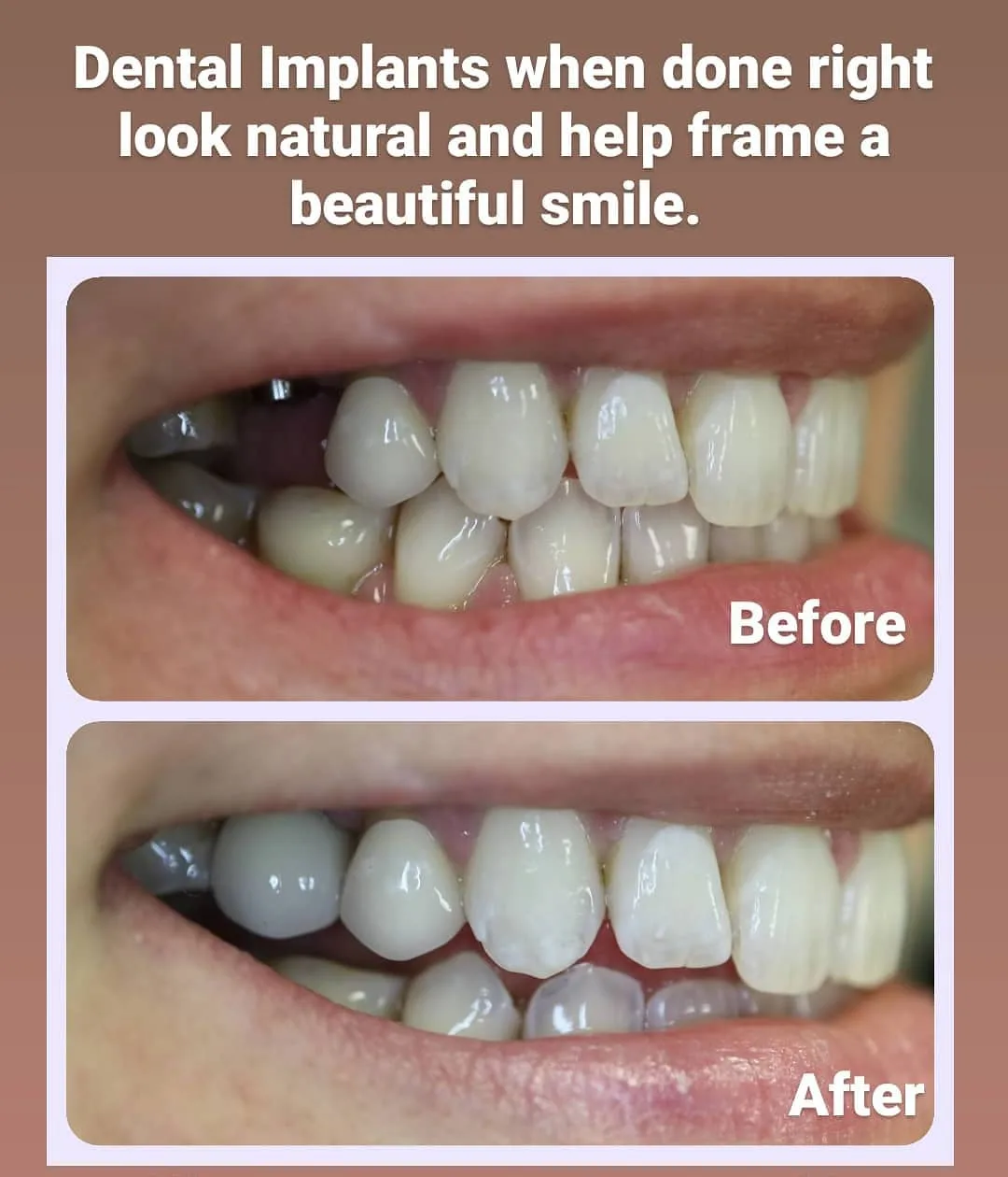 Before and after view of a dental implant replacing a missing upper molar, Loukas Dentistry of Park Ridge, Illinois