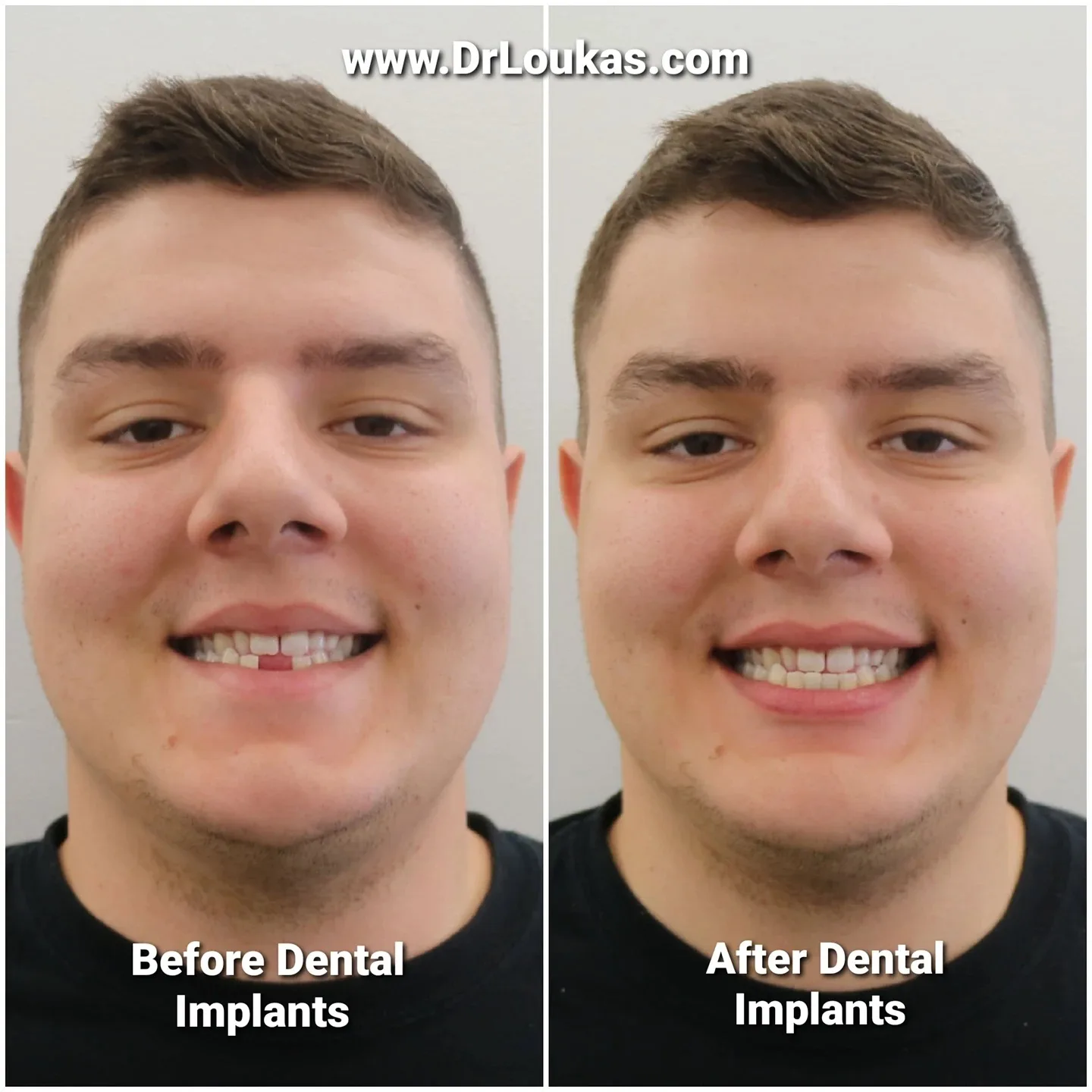 Before and after dental implants restoring a full smile, Loukas Dentistry of Park Ridge, Illinois