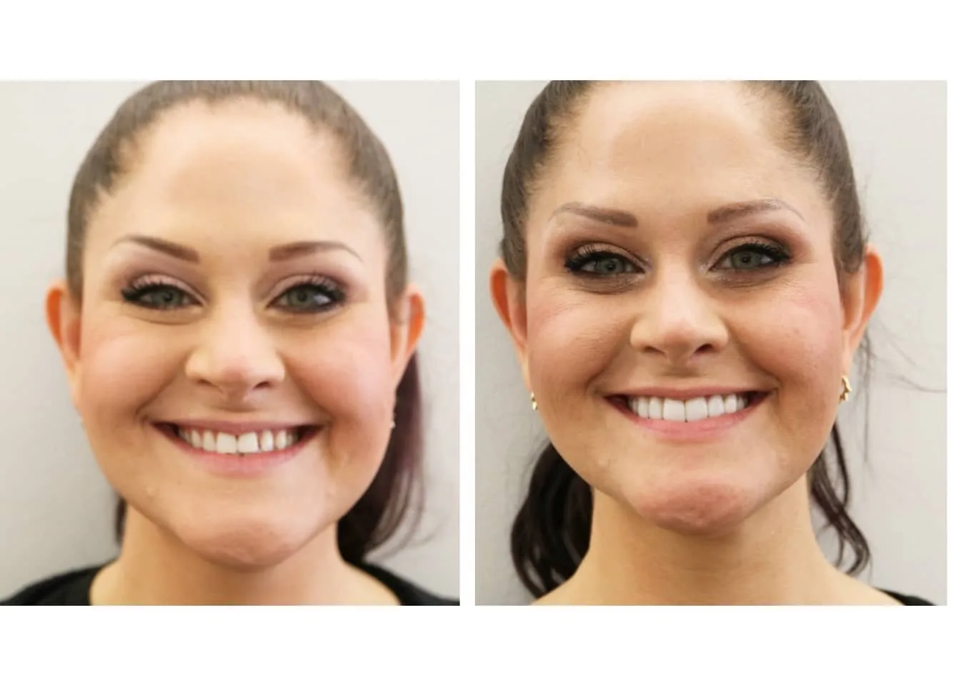 Before and after facial aesthetics treatment refreshing the overall appearance, Loukas Dentistry of Park Ridge, Illinois
