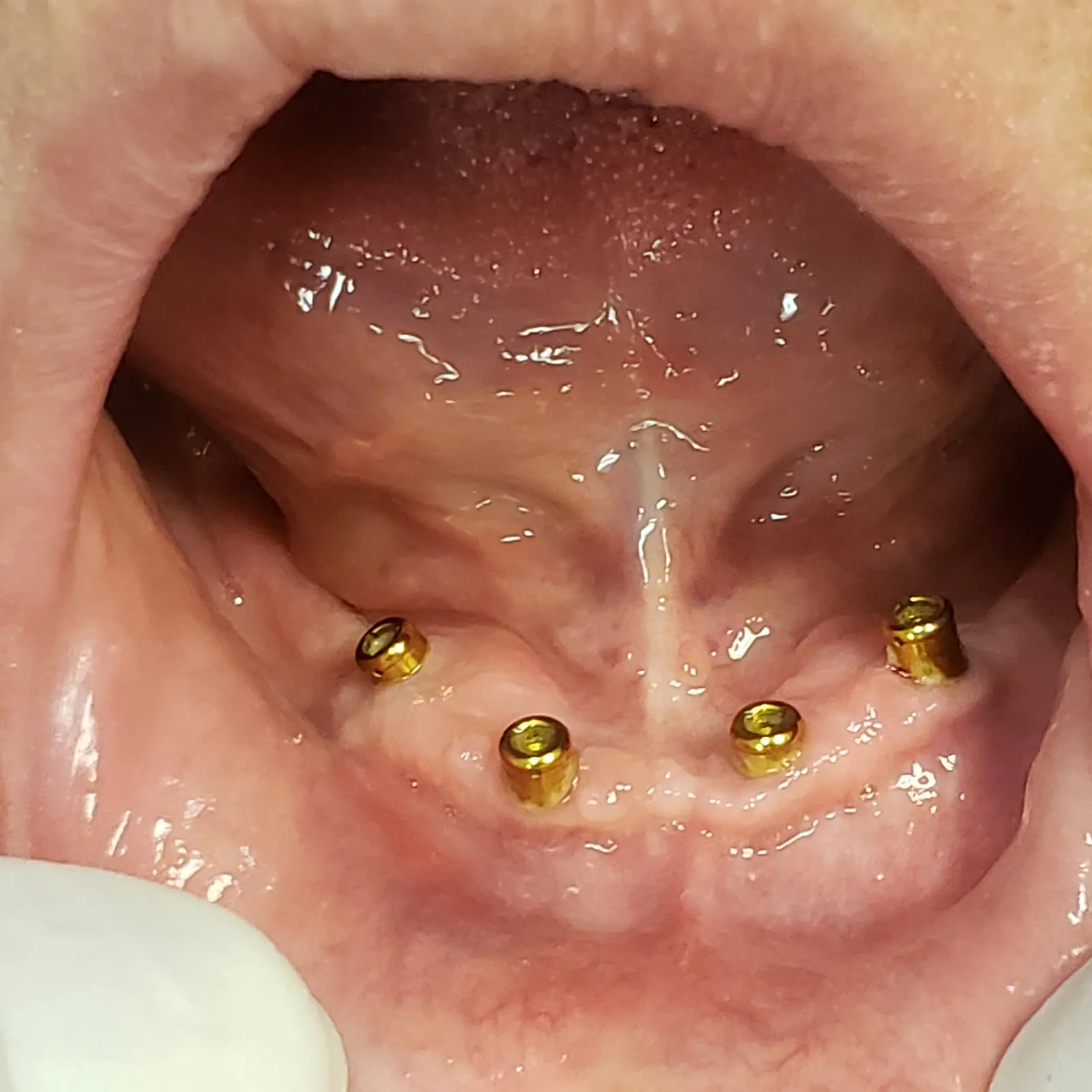 Four Locator Implant Abutments in the Lower Jaw Park Ridge Il Loukas Dentistry of Park Ridge Four dental implants with gold Locator abutments in the lower jaw, ready for a snap-in implant denture, Loukas Dentistry Park Ridge, IL