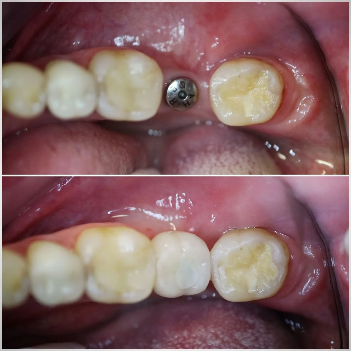 Before and after of an implant abutment restored with a tooth colored crown on an upper molar, Loukas Dentistry of Park Ridge, Illinois