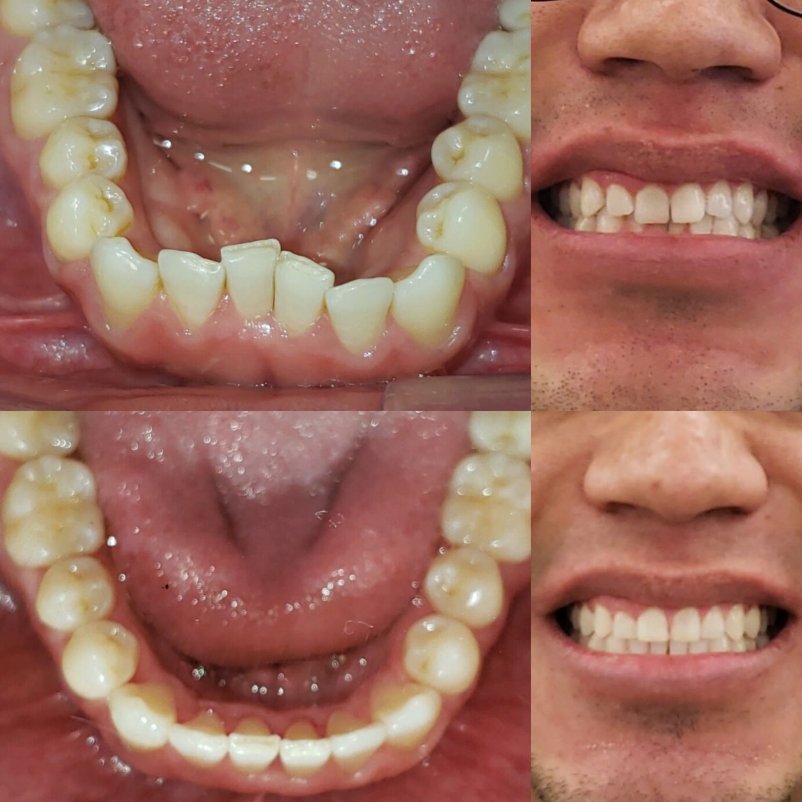 Invisalign Before and After Lower Crowding Corrected Park Ridge Il Loukas Dentistry of Park Ridge Invisalign before and after at Loukas Dentistry Park Ridge, IL: crowded lower front teeth aligned with clear aligners