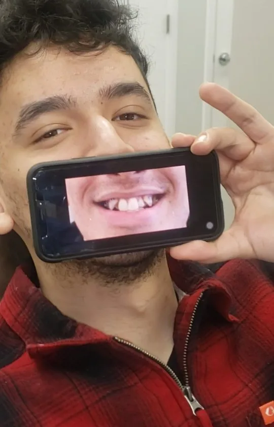 Patient showing a before photo of crowded teeth next to his straightened smile after clear aligner treatment, Loukas Dentistry of Park Ridge, Illinois