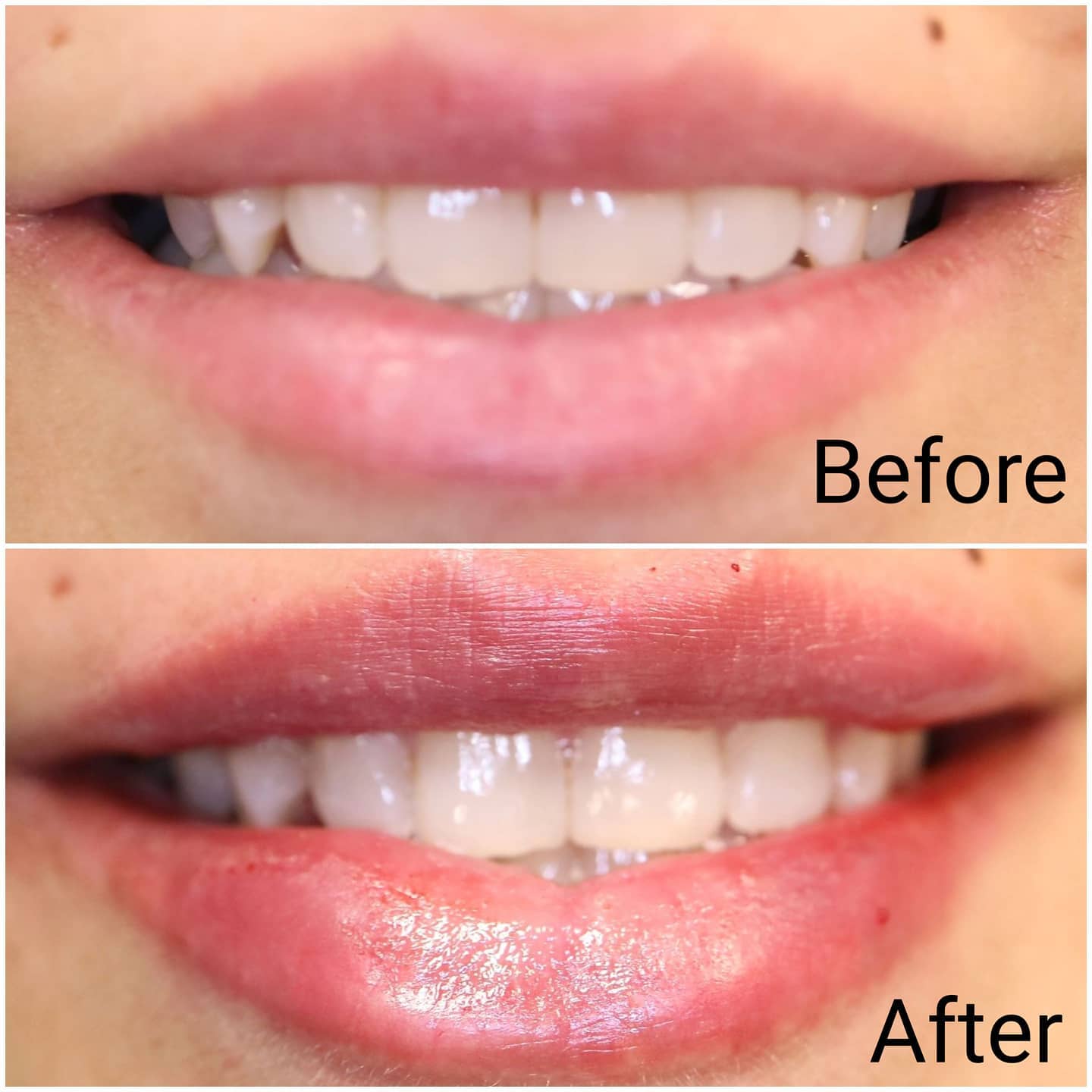 Before and after Juvederm lip filler adding fullness to the upper and lower lip, Loukas Dentistry of Park Ridge, Illinois