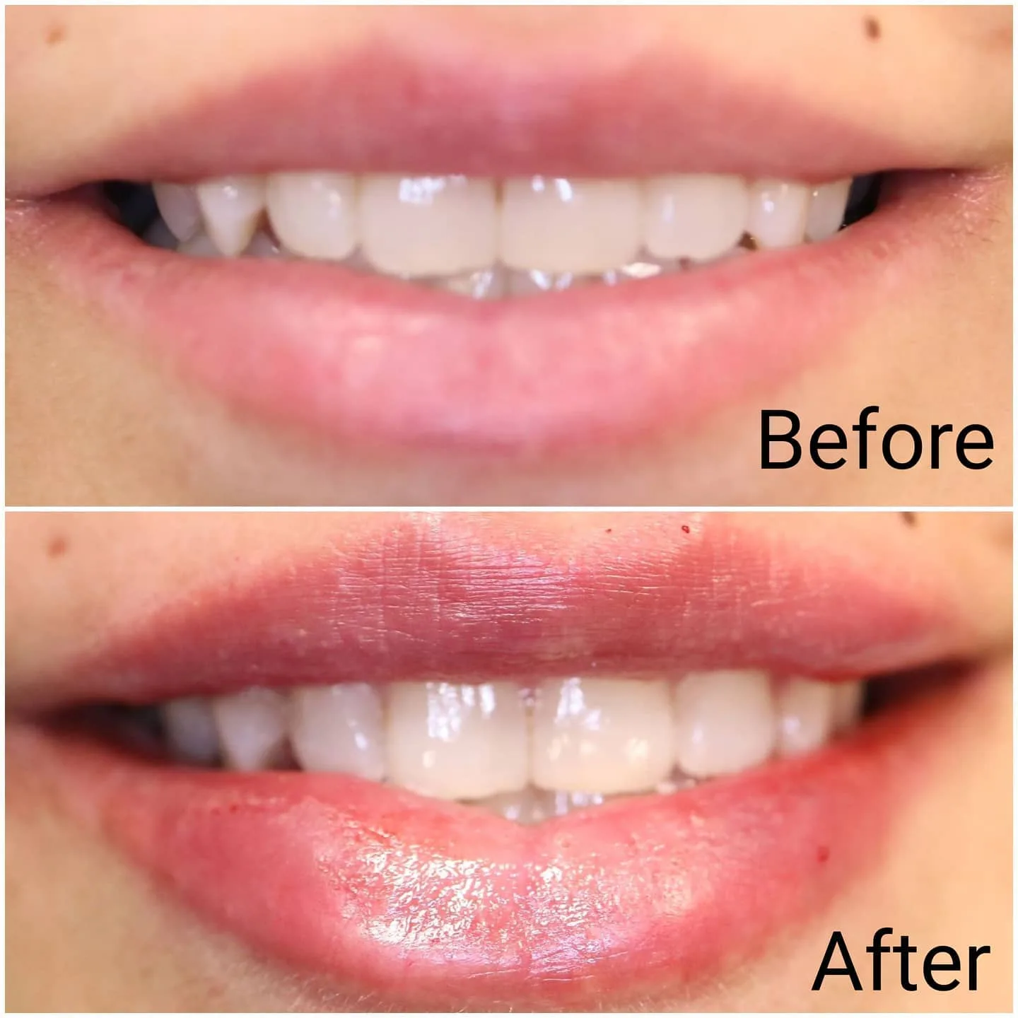 Before and after Juvederm lip filler adding fullness to the upper and lower lip, Loukas Dentistry of Park Ridge, Illinois