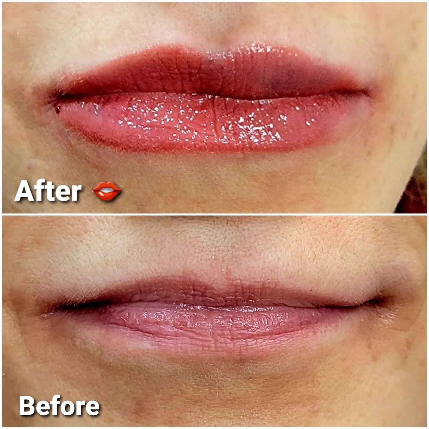 Before and after lip enhancement with dermal filler, Loukas Dentistry of Park Ridge, Illinois