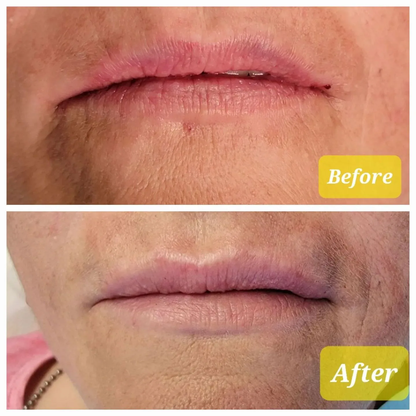 Before and after lip filler smoothing dry, lined lips, Loukas Dentistry of Park Ridge, Illinois
