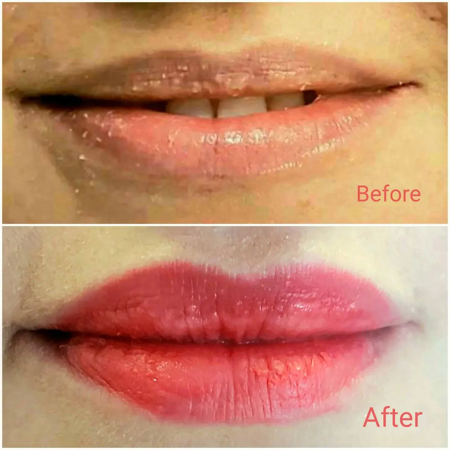 Before and after lip filler restoring shape and definition to thin lips, Loukas Dentistry of Park Ridge, Illinois