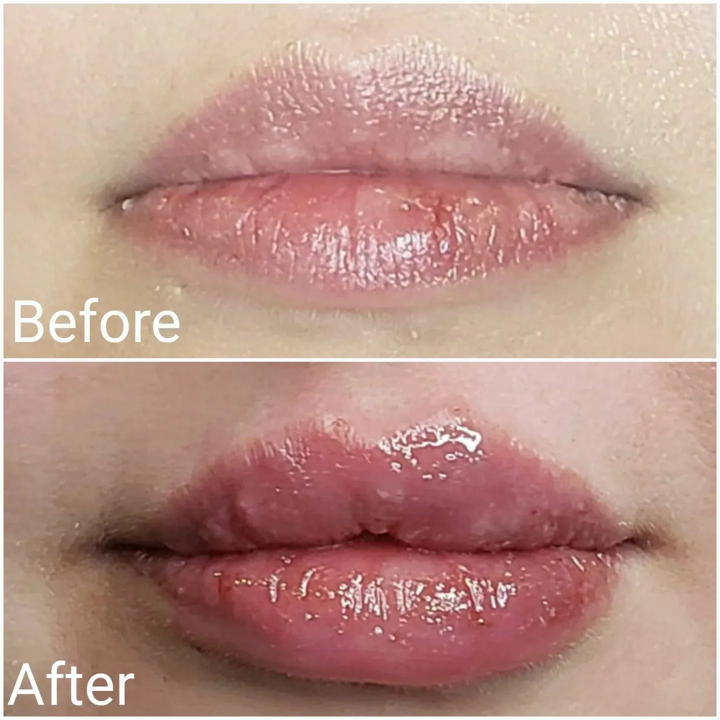 Before and after a subtle lip filler enhancement keeping a natural shape, Loukas Dentistry of Park Ridge, Illinois