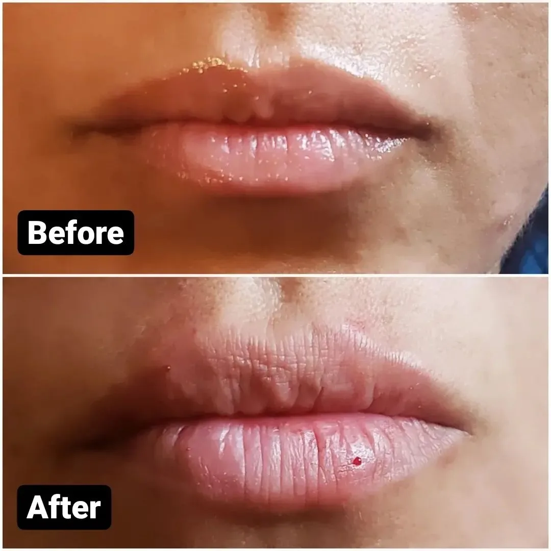 Before and after lip filler adding balanced volume to both lips, Loukas Dentistry of Park Ridge, Illinois