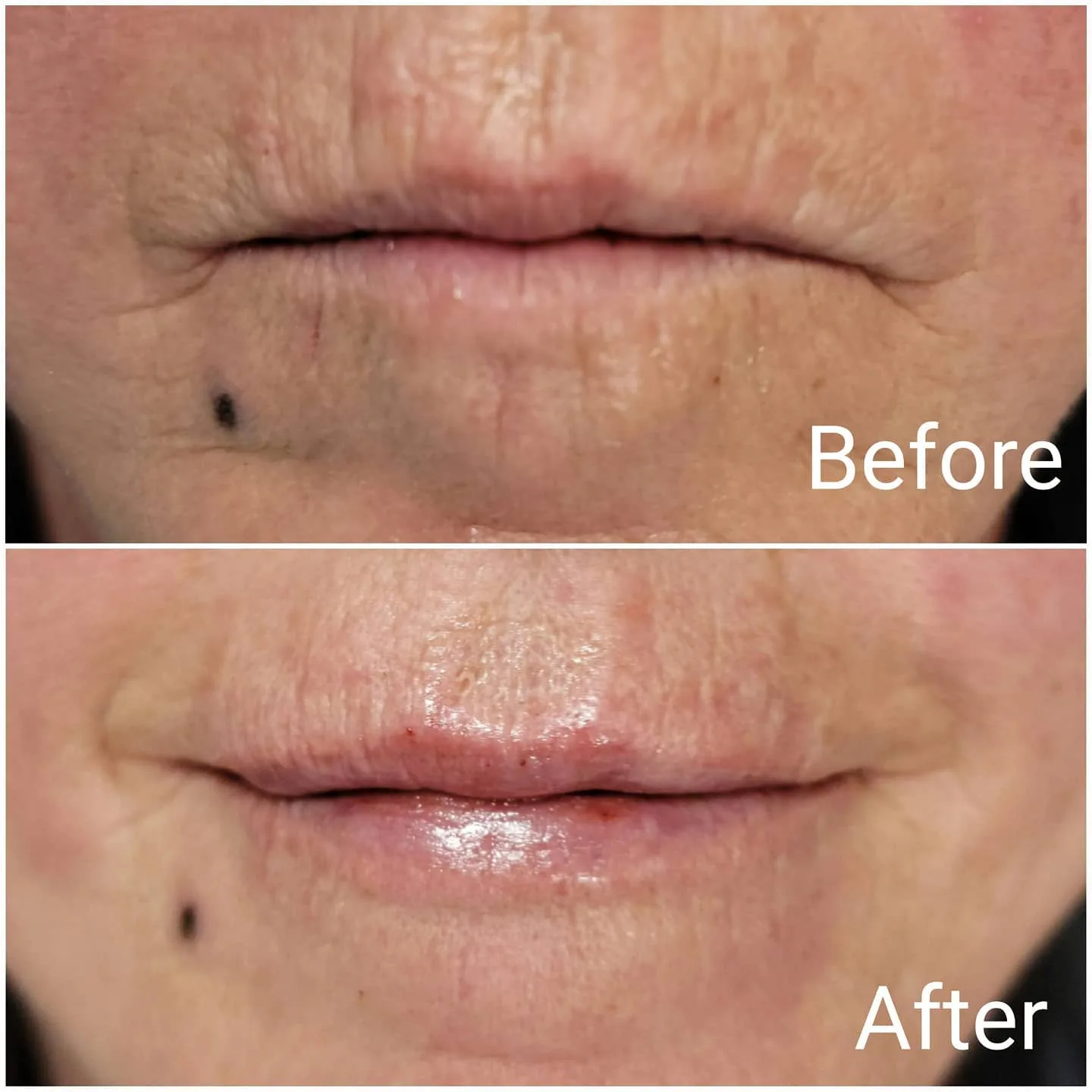 Before and after dermal filler softening vertical lip lines, Loukas Dentistry of Park Ridge, Illinois