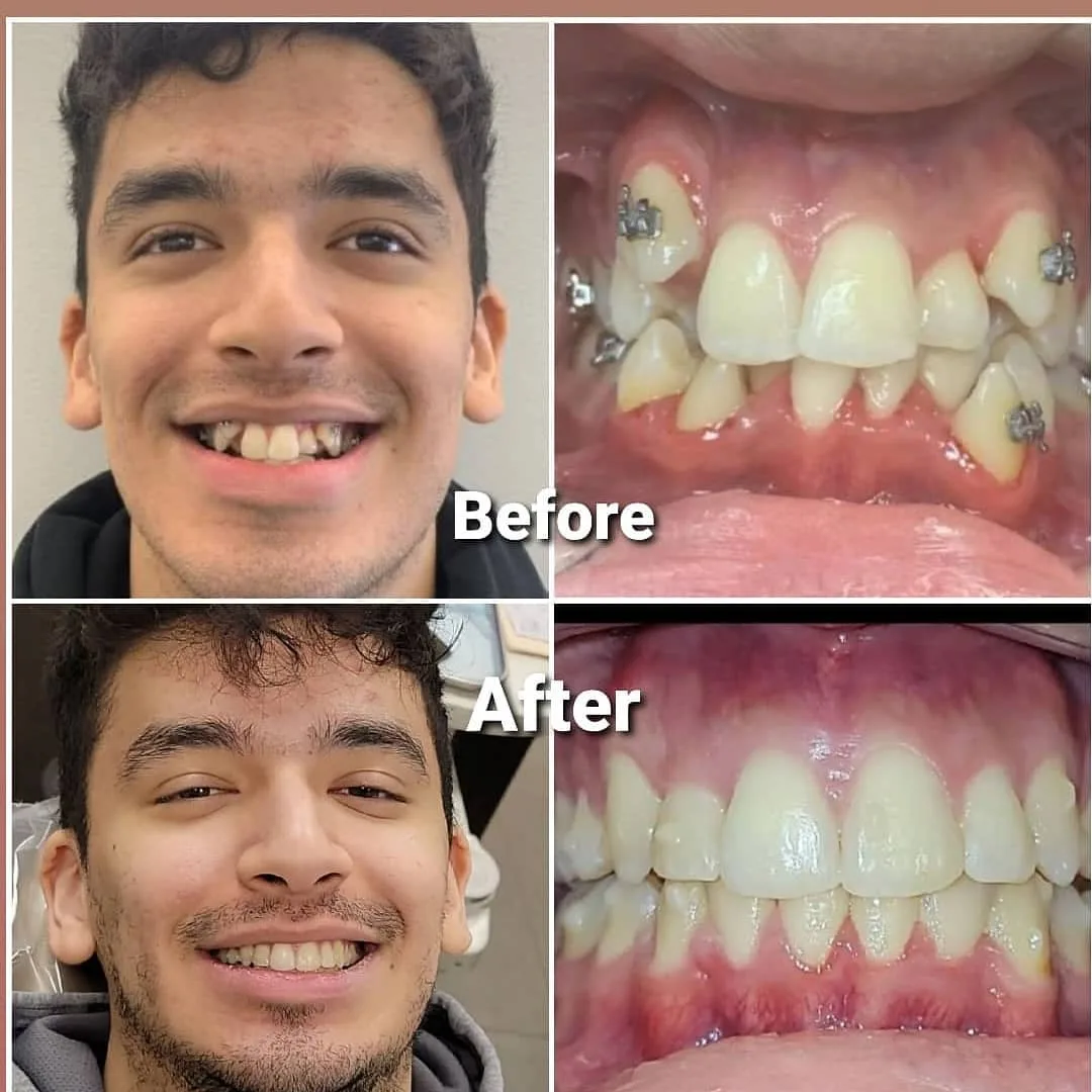 Before and after orthodontic treatment straightening crowded teeth, Loukas Dentistry of Park Ridge, Illinois