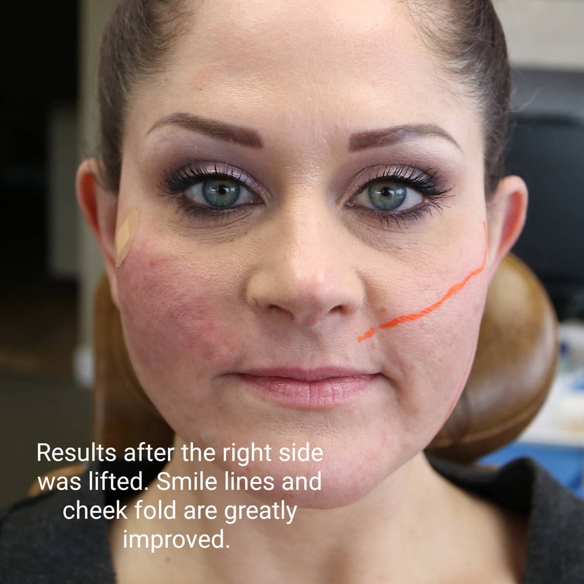 Half-face comparison after PDO lifting threads were placed on one side, showing improved smile lines and cheek fold, at Loukas Dentistry in Park Ridge, IL