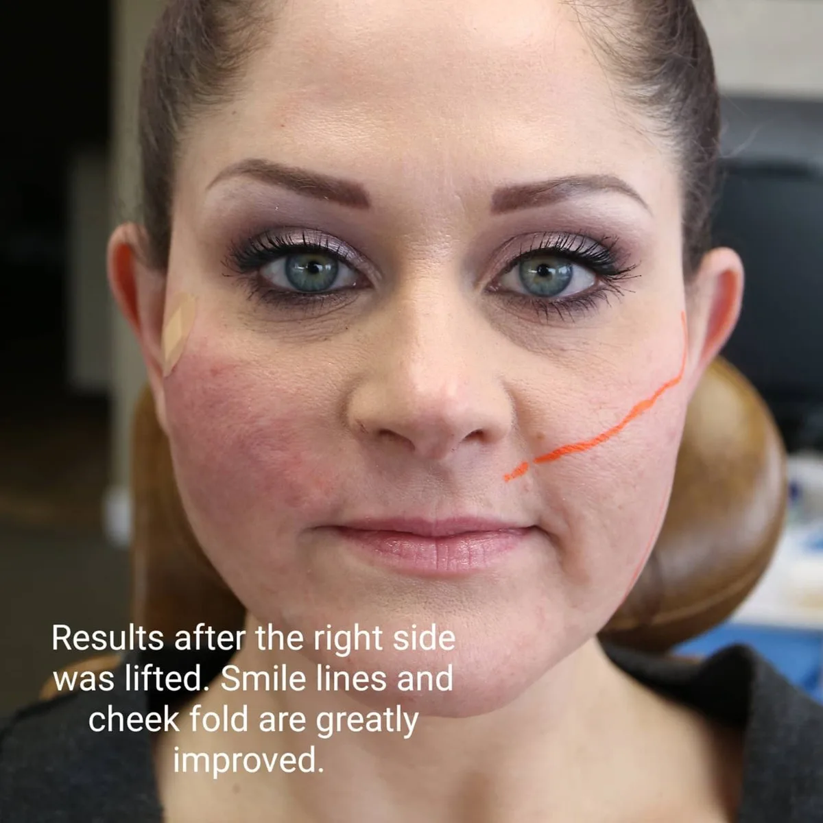 Half-face comparison after PDO lifting threads were placed on one side, showing improved smile lines and cheek fold, at Loukas Dentistry in Park Ridge, IL