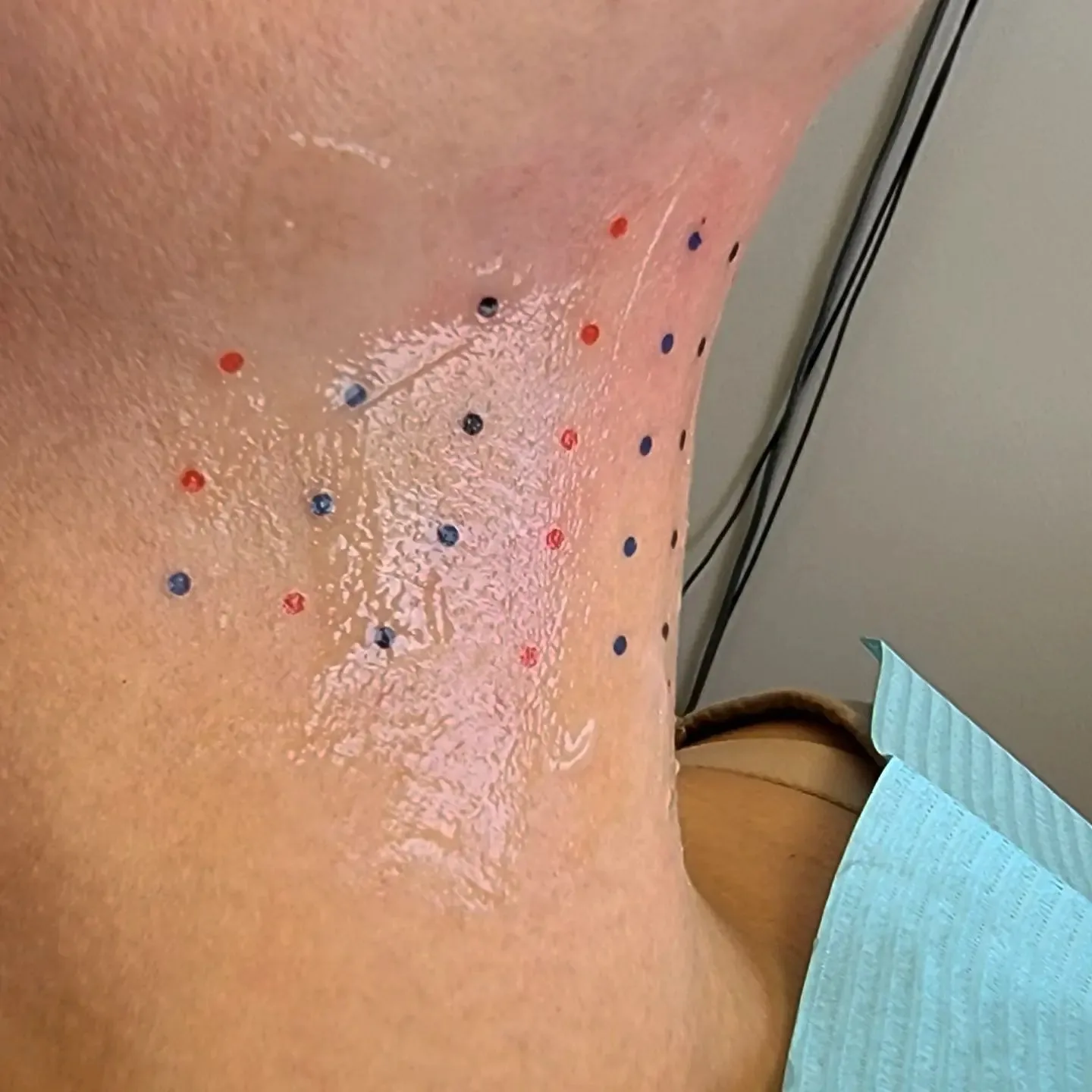 PDO thread lift treatment points mapped on the skin, Loukas Dentistry of Park Ridge, Illinois