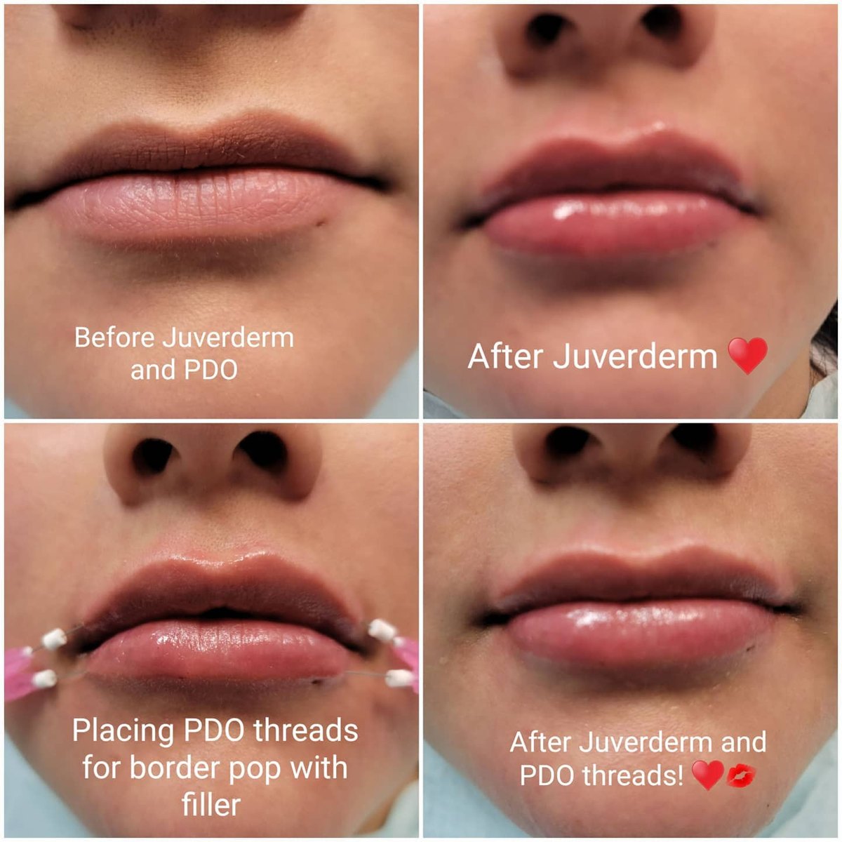 Four-stage lip series showing before Juvederm and PDO threads, after filler, PDO threads being placed at the lip border, and the final result, at Loukas Dentistry in Park Ridge, IL
