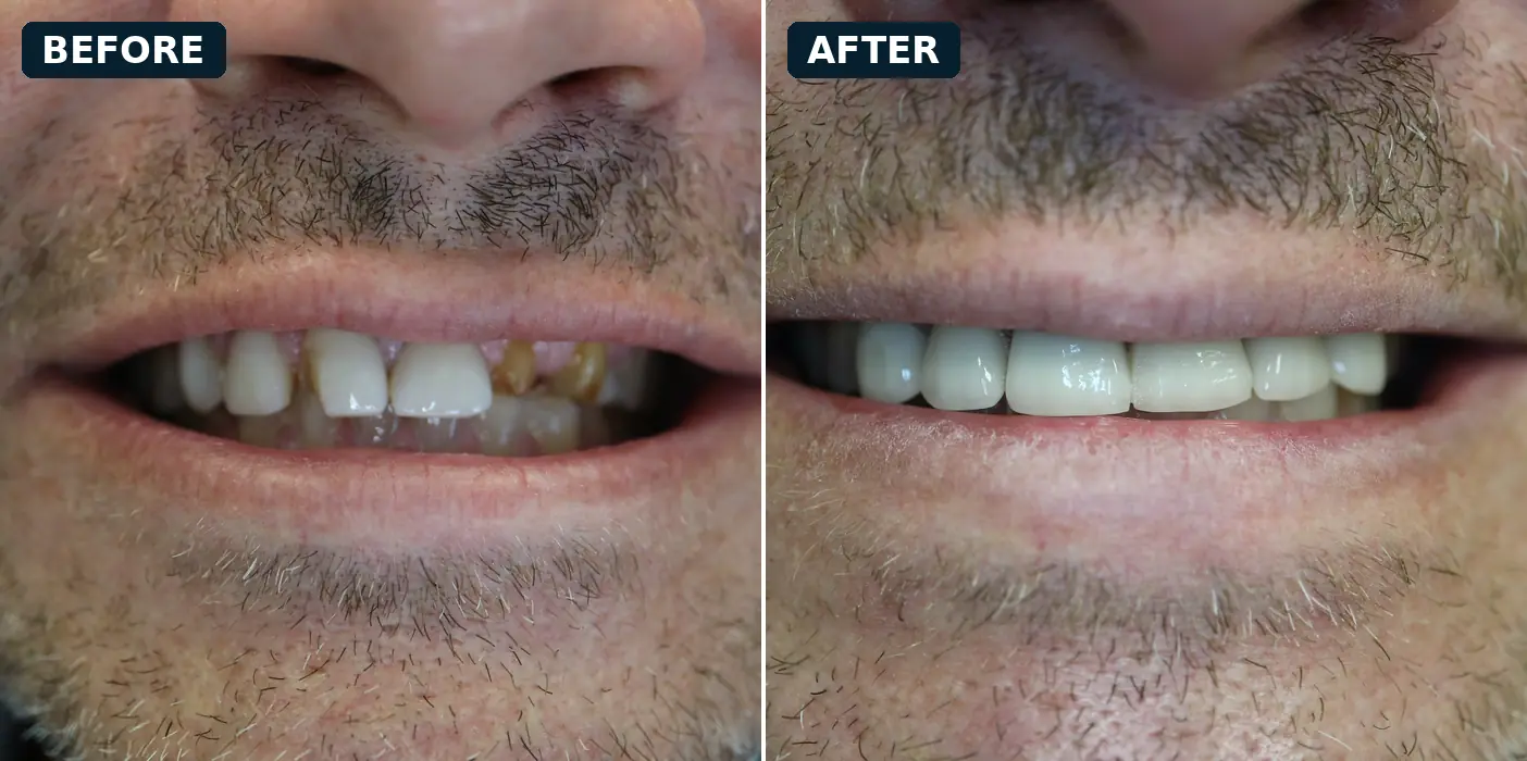 Porcelain crowns on the front teeth before and after treatment at Loukas Dentistry in Park Ridge, IL