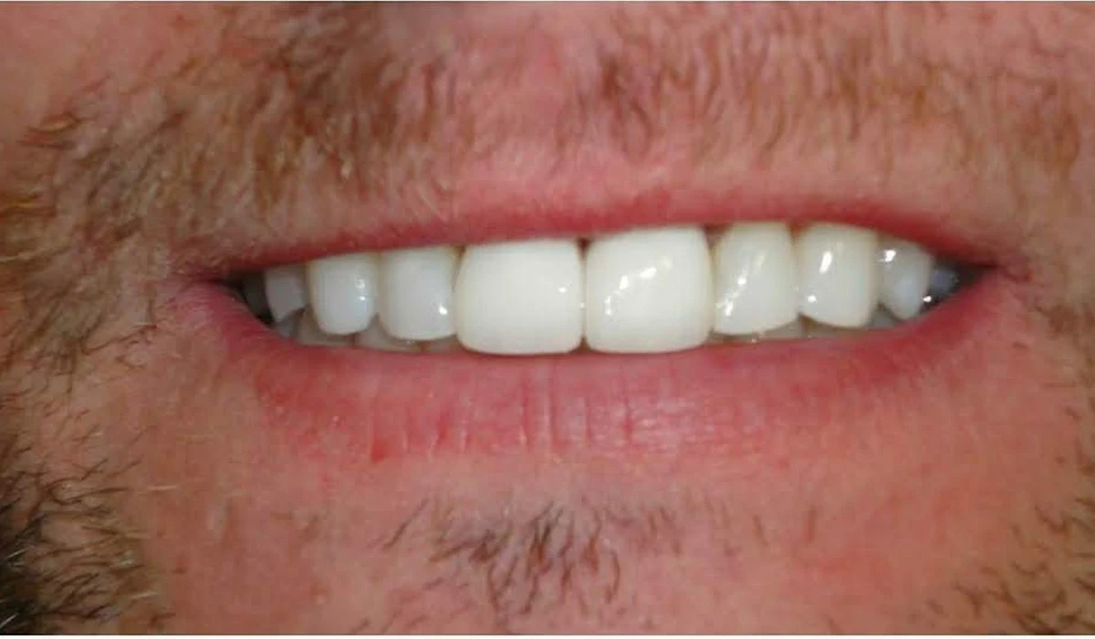 Dental Crowns