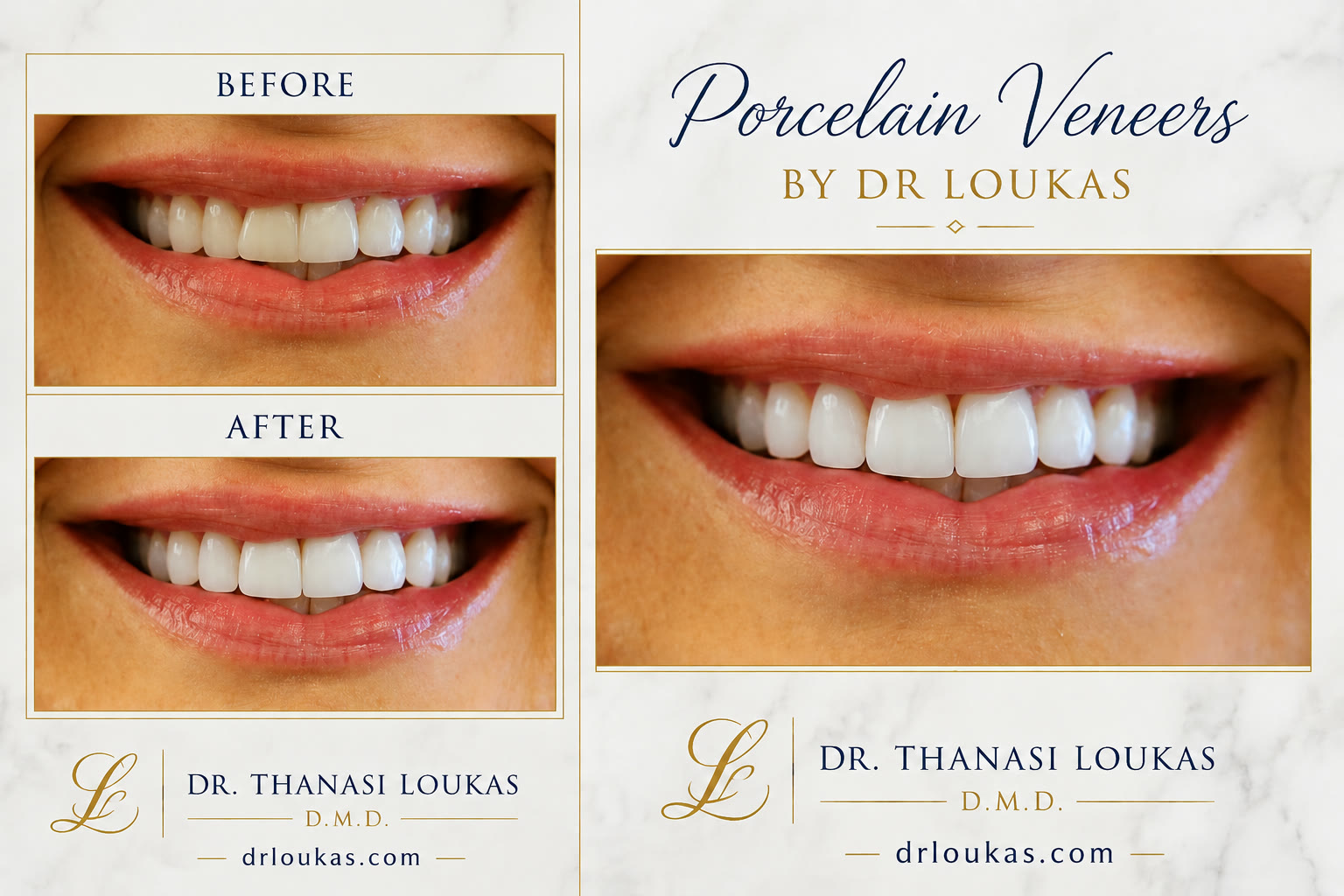 Porcelain Veneers Before and After by Dr Loukas Park Ridge Il Loukas Dentistry of Park Ridge Before and after porcelain veneers by Dr. Thanasi Loukas, DMD in Park Ridge, IL