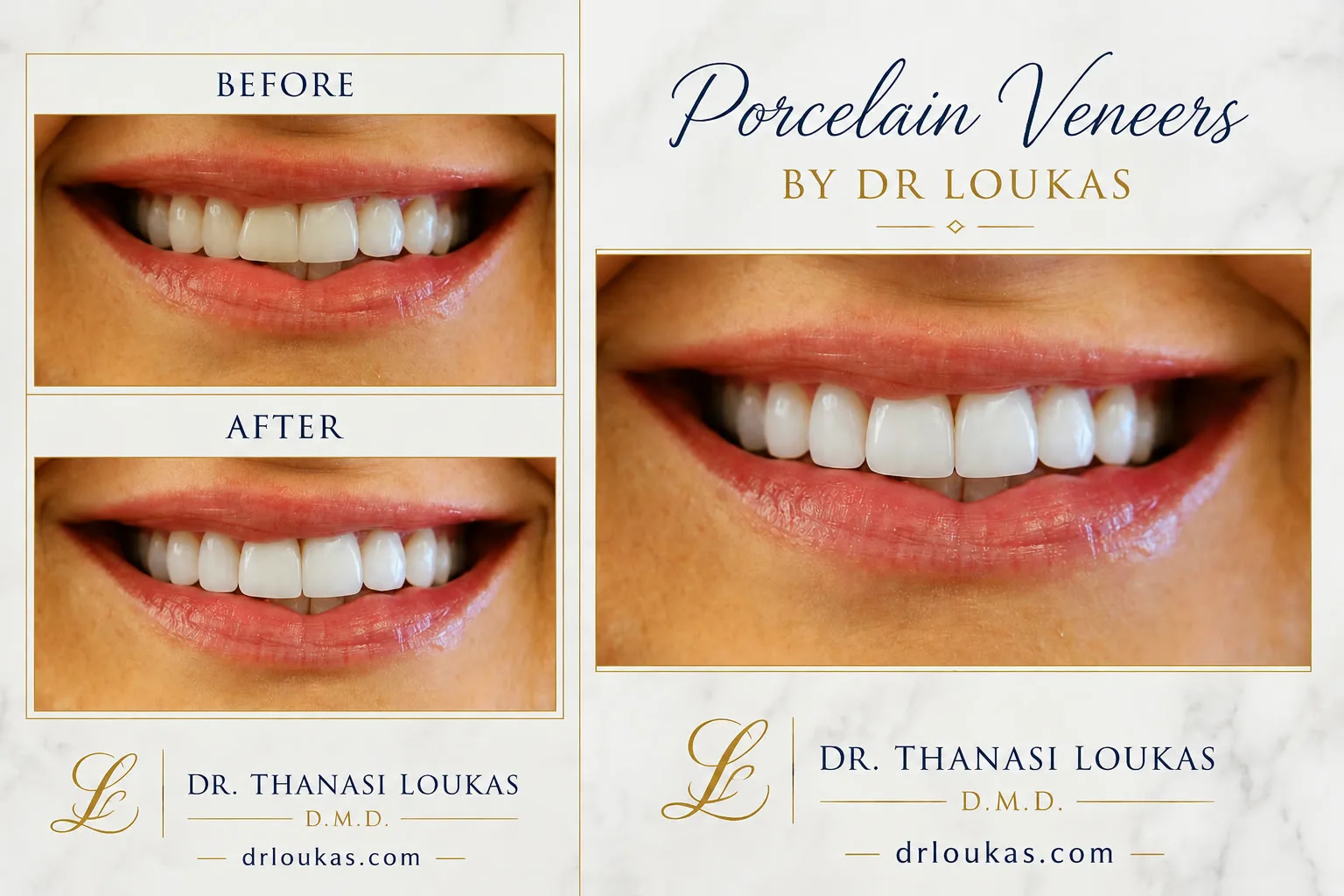 Porcelain Veneers Before and After by Dr Loukas Park Ridge Il Loukas Dentistry of Park Ridge Before and after porcelain veneers by Dr. Thanasi Loukas, DMD in Park Ridge, IL