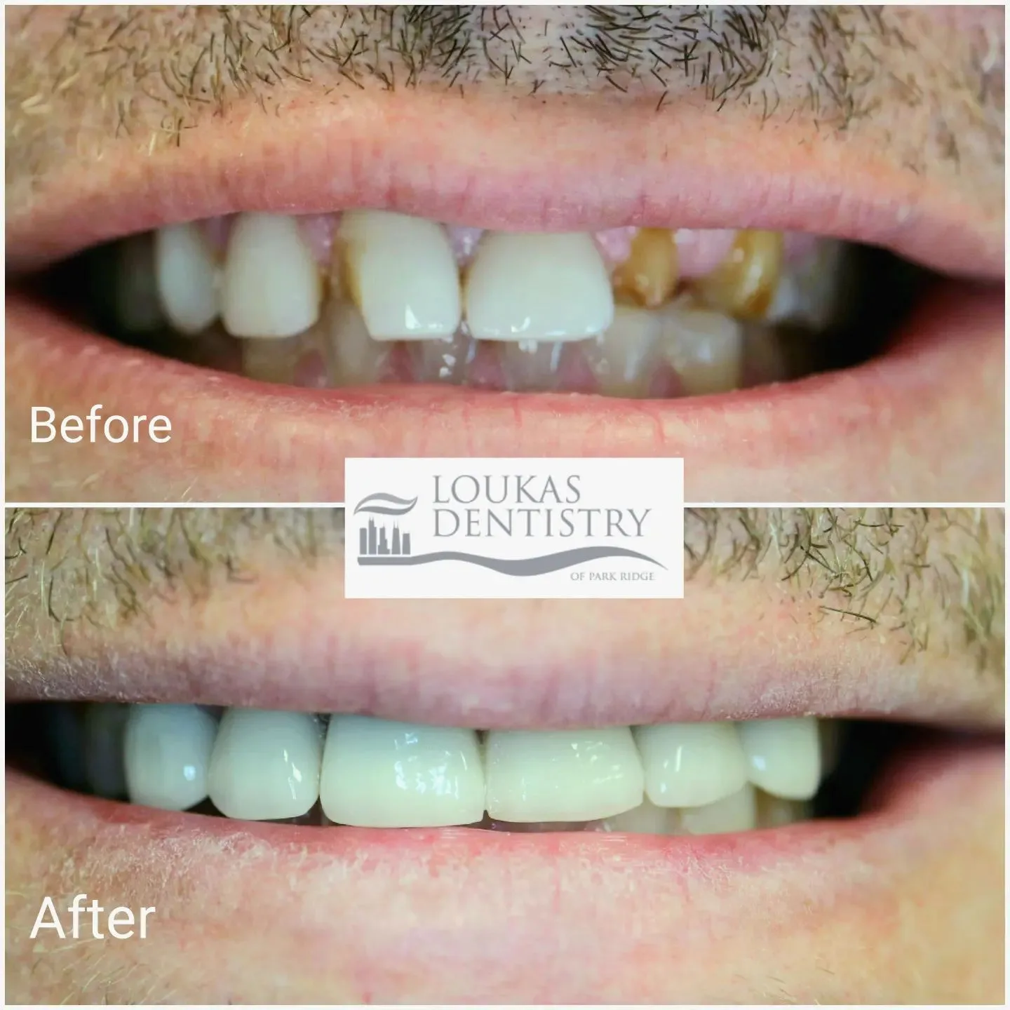 Before and after porcelain veneers on the upper front teeth, Loukas Dentistry of Park Ridge, Illinois