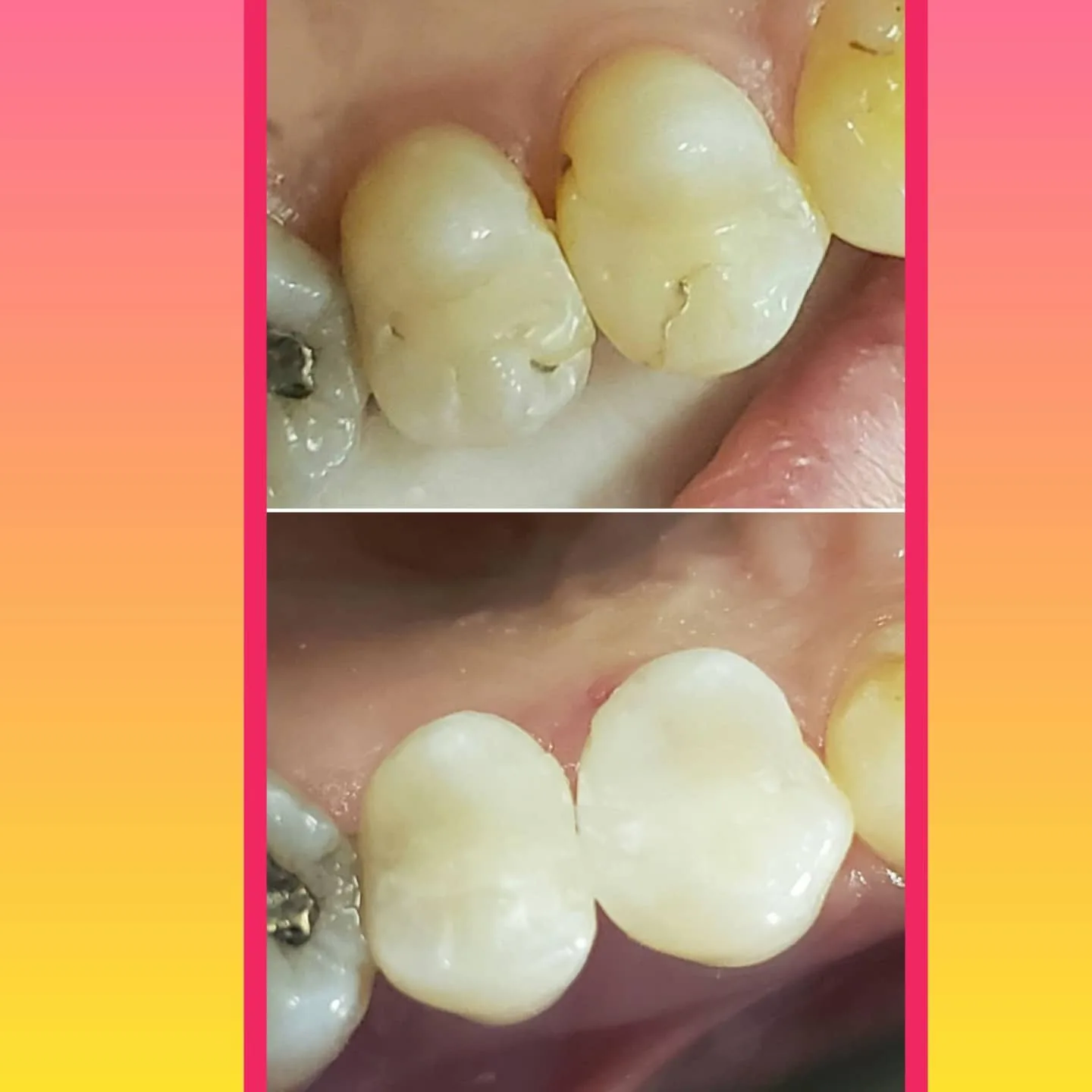 Before and after a white composite filling on a premolar, Loukas Dentistry of Park Ridge, Illinois