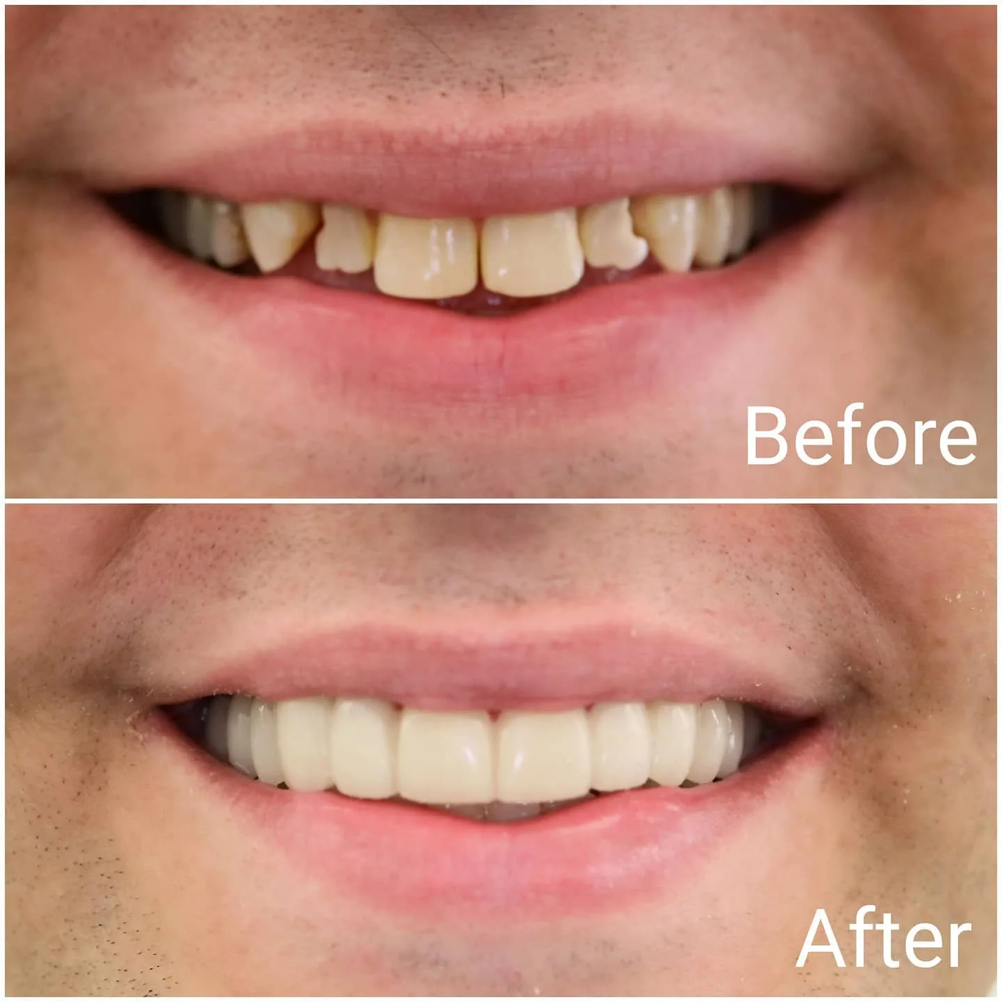 Before and after smile makeover correcting worn and uneven front teeth, Loukas Dentistry of Park Ridge, Illinois