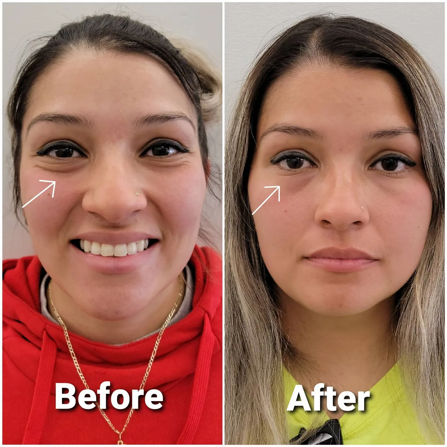 Before and after dermal filler smoothing hollows under the eyes, Loukas Dentistry of Park Ridge, Illinois