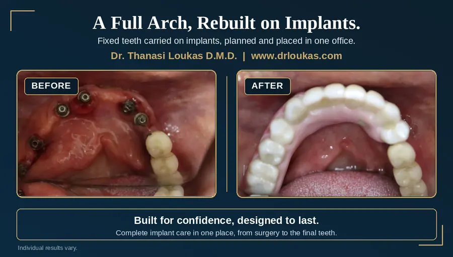 Before and after photo of a full arch upper restoration on dental implants at Loukas Dentistry in Park Ridge, IL. Before shows implant abutments in a healing arch, after shows a fixed full arch implant bridge.