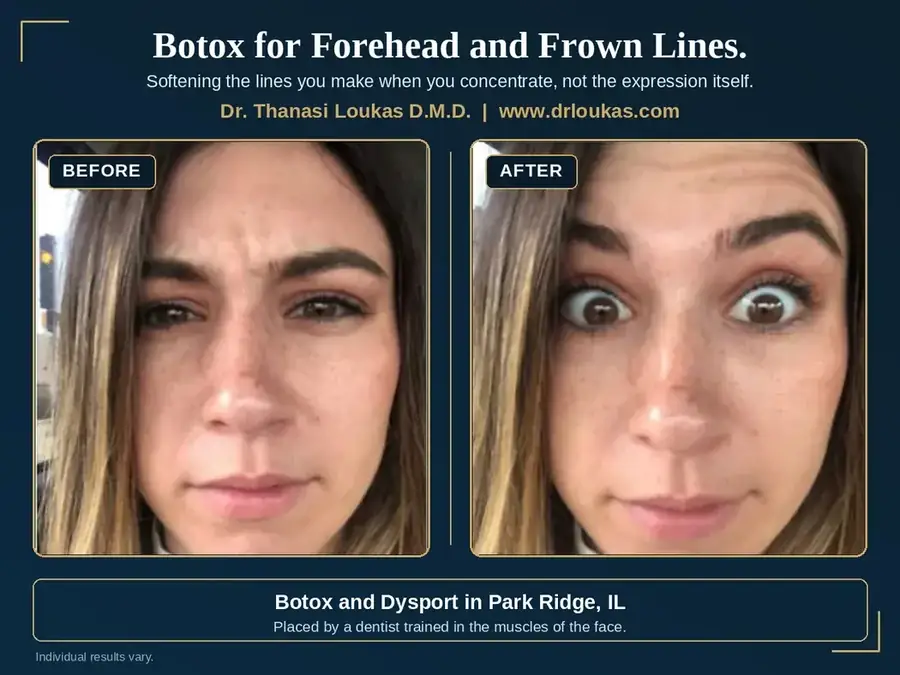 Before and after Botox treatment for forehead lines and frown lines between the eyebrows, Loukas Dentistry of Park Ridge, IL