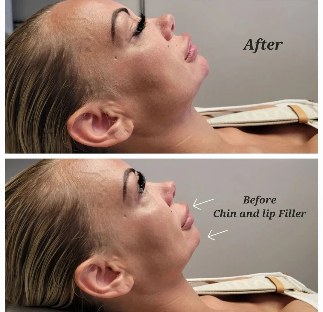 Side profile before and after chin and lip filler at Loukas Dentistry of Park Ridge, Illinois, with the before view labelled below and the after view above
