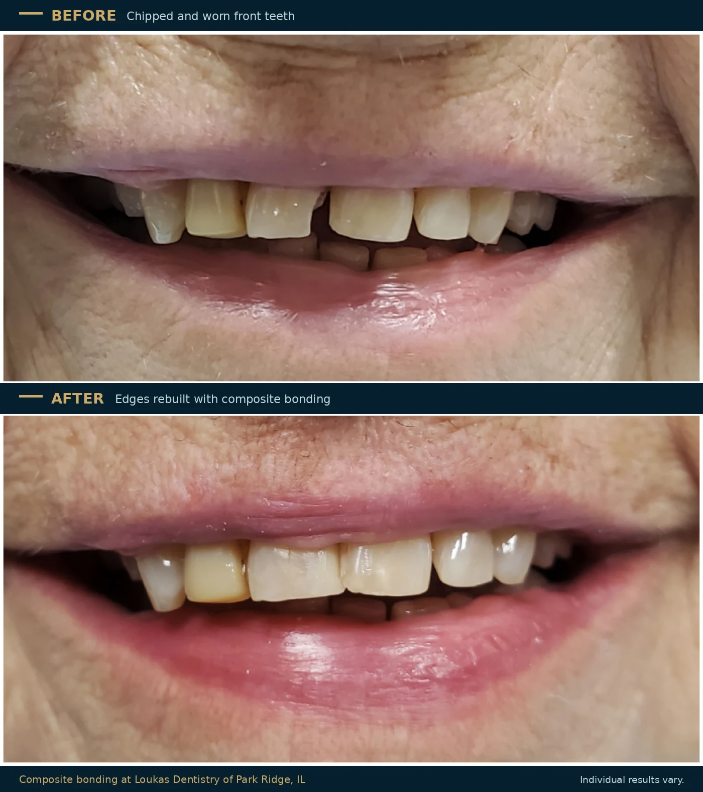 Before and after composite bonding at Loukas Dentistry of Park Ridge, Illinois, showing chipped and worn upper front teeth rebuilt with tooth coloured resin