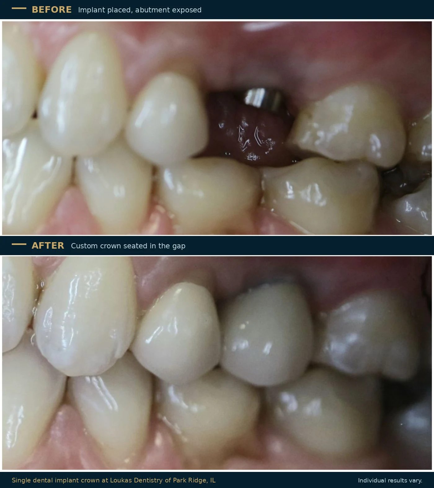 Before and after a single dental implant crown at Loukas Dentistry of Park Ridge, Illinois, showing the exposed implant abutment in the gap and the finished porcelain crown seated in its place