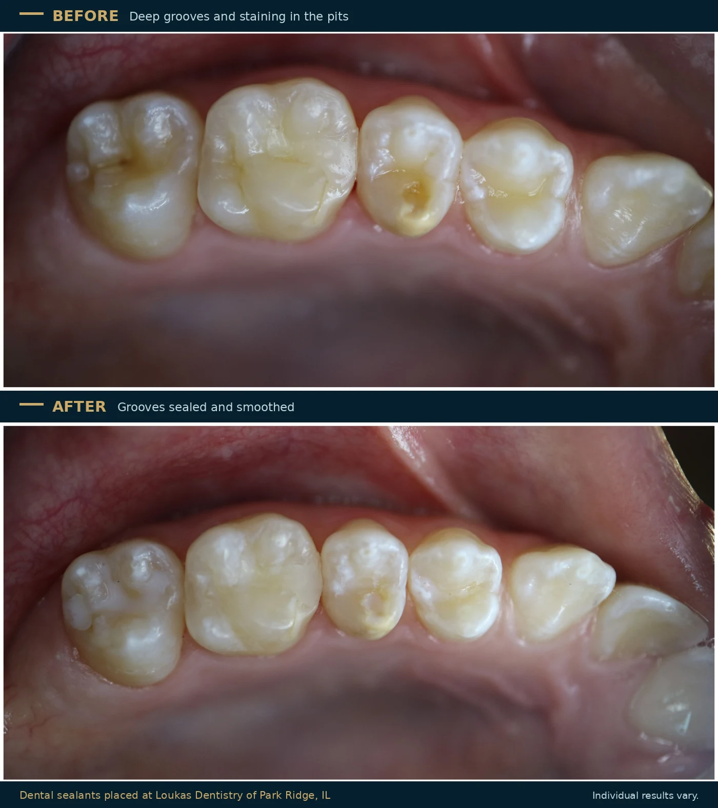 Before and after dental sealants at Loukas Dentistry of Park Ridge, Illinois, showing deep stained grooves in the premolars and molars before treatment and the same grooves sealed and smooth afterward