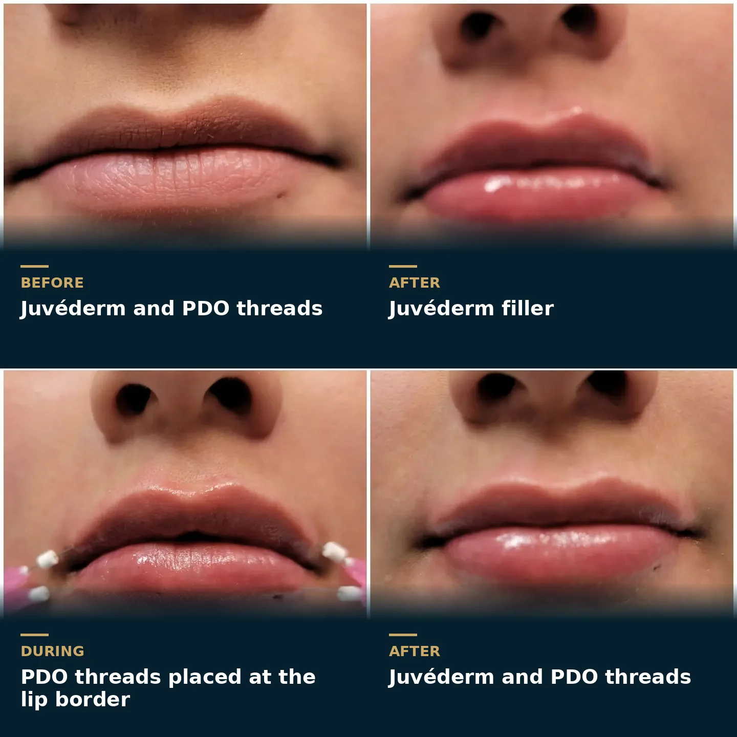 Four-stage lip series showing before Juvederm and PDO threads, after filler, PDO threads being placed at the lip border, and the final result, at Loukas Dentistry in Park Ridge, IL