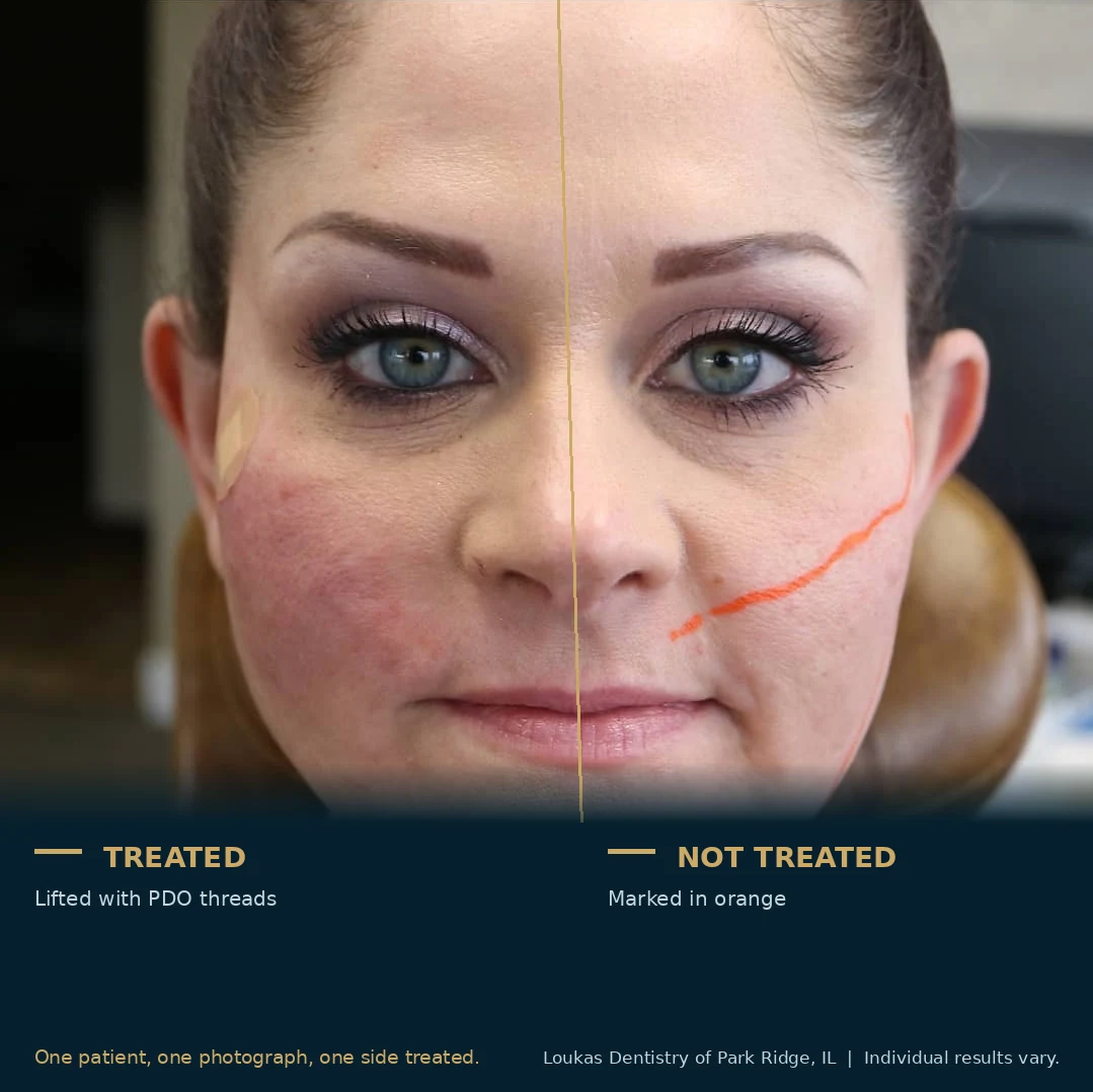 Split face PDO thread lift comparison at Loukas Dentistry of Park Ridge, Illinois, with the treated side lifted on the left and the untreated side marked in orange on the right, in the same patient and the same photograph