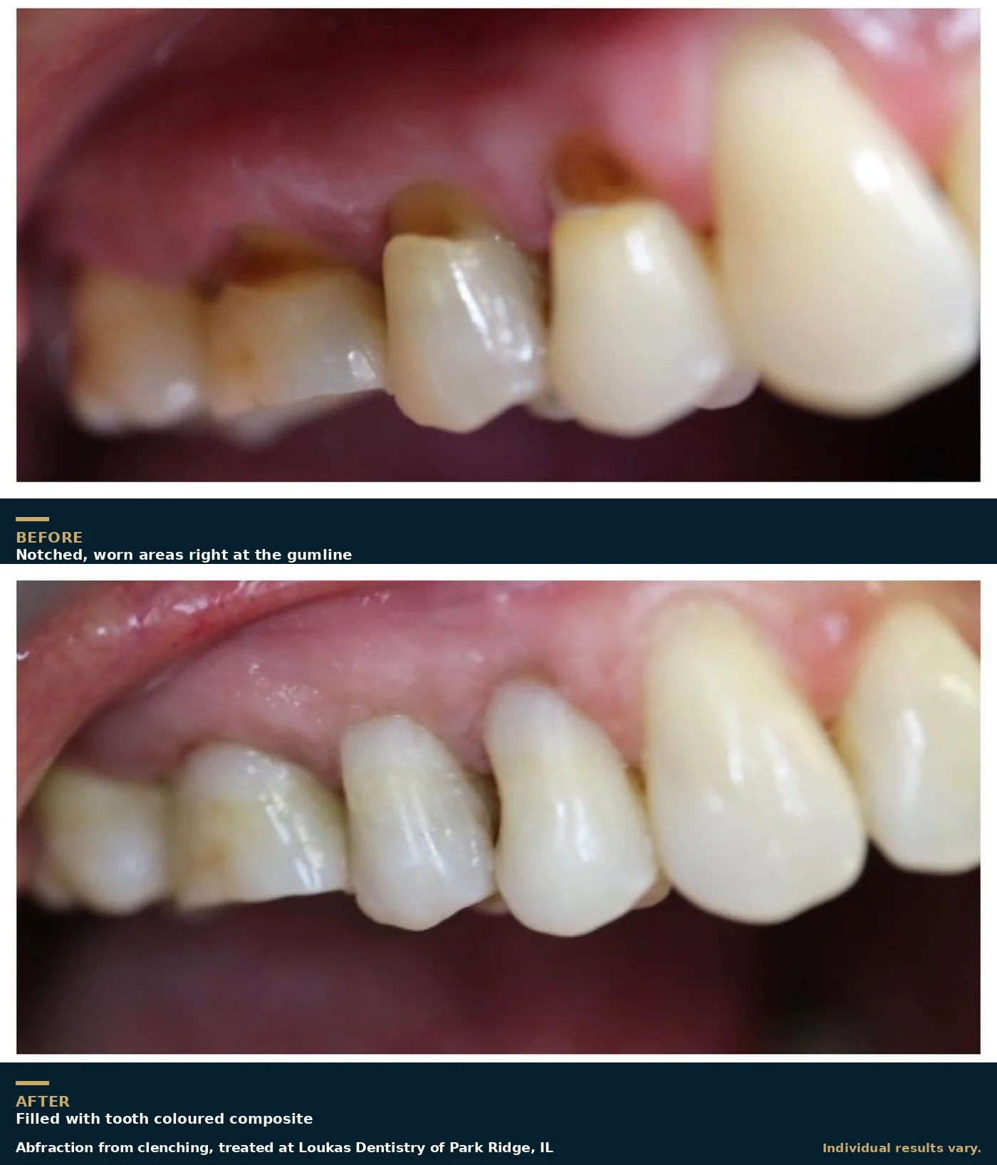 Before and after of abfraction notches at the gumline caused by clenching, restored with composite at Loukas Dentistry of Park Ridge, IL