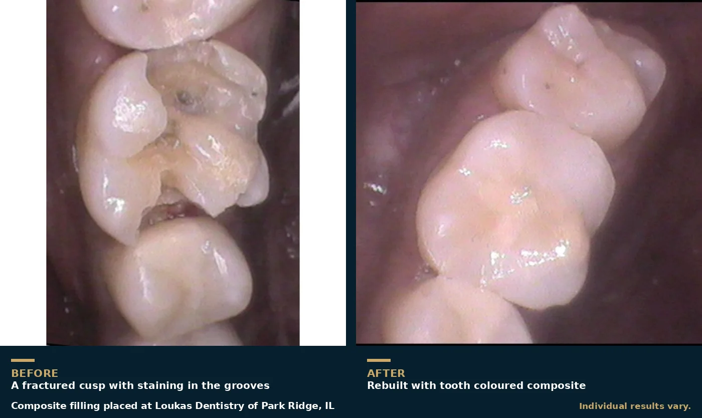 Before and after of a composite filling replacing a fractured and decayed molar surface at Loukas Dentistry of Park Ridge, IL