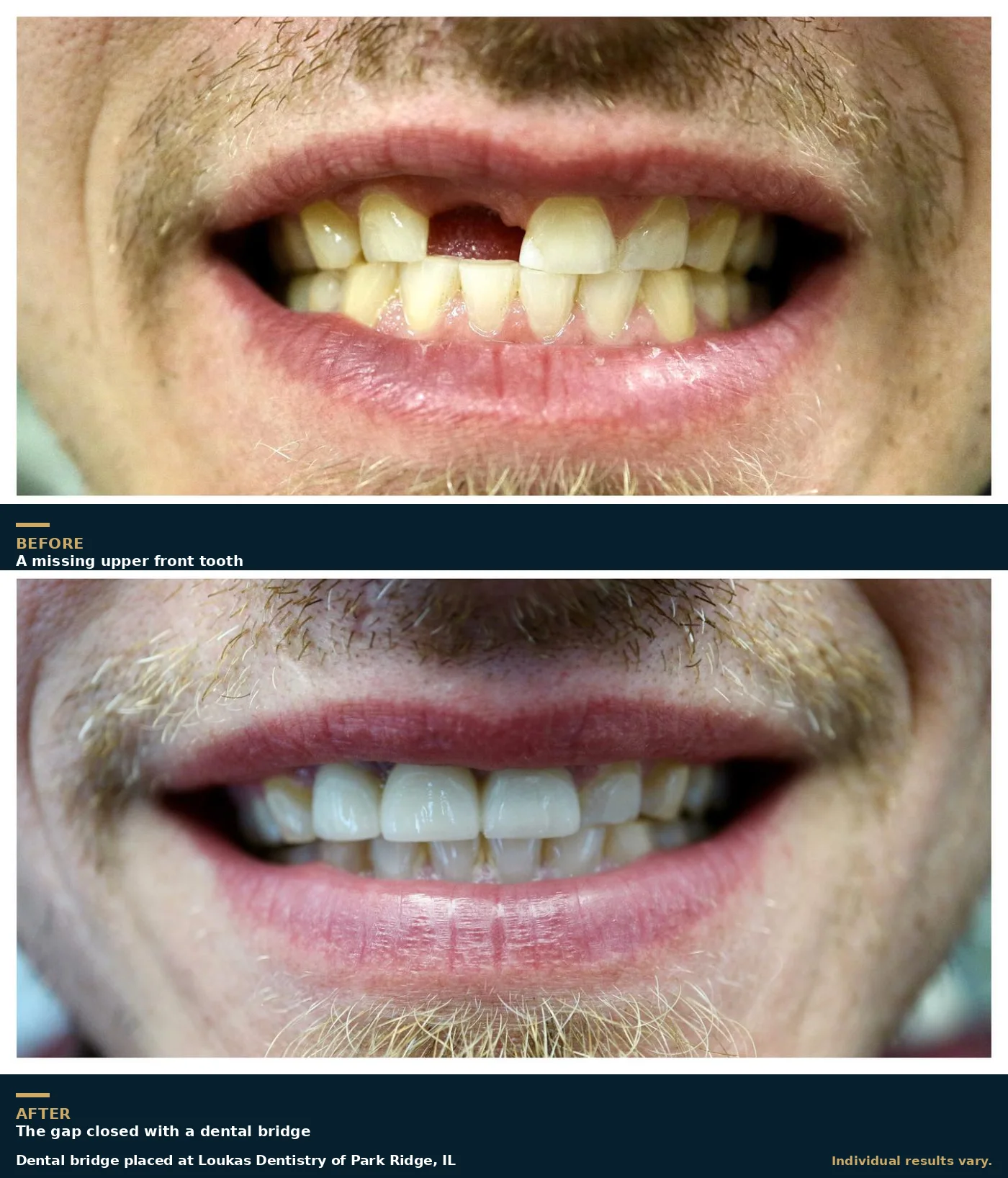 Before and after of a dental bridge in Park Ridge, IL, showing a missing upper front tooth and the completed bridge