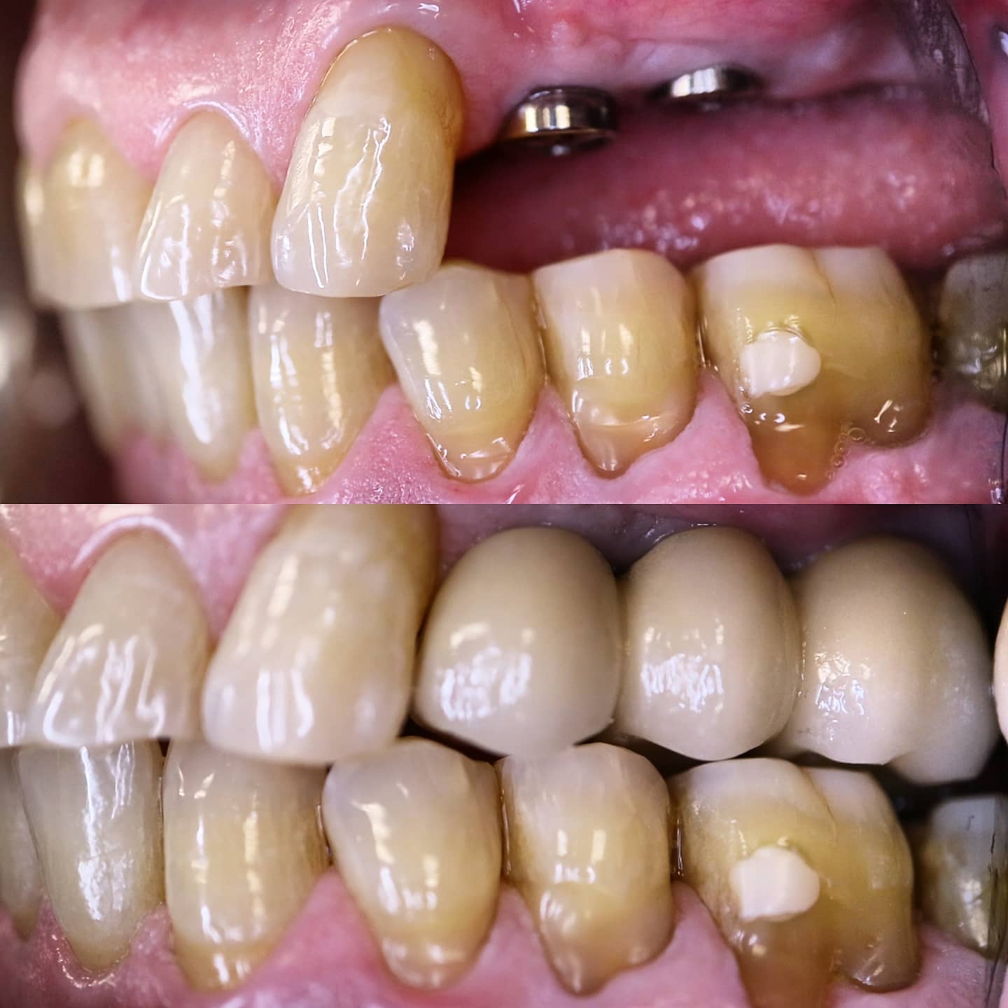 Before and after dental implants with porcelain crowns replacing lower teeth, Loukas Dentistry of Park Ridge, IL