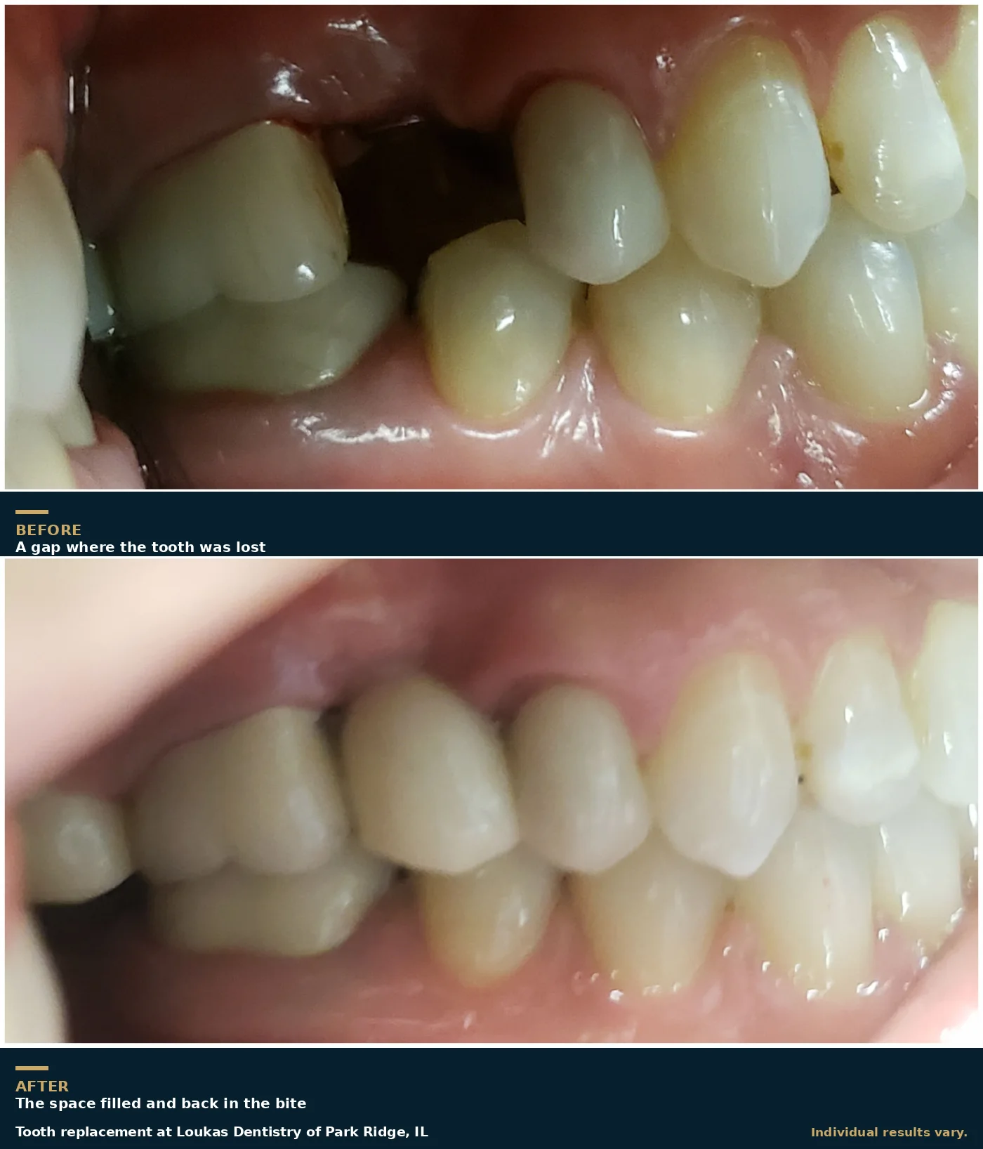 Before and after of a missing tooth replaced at Loukas Dentistry of Park Ridge, IL