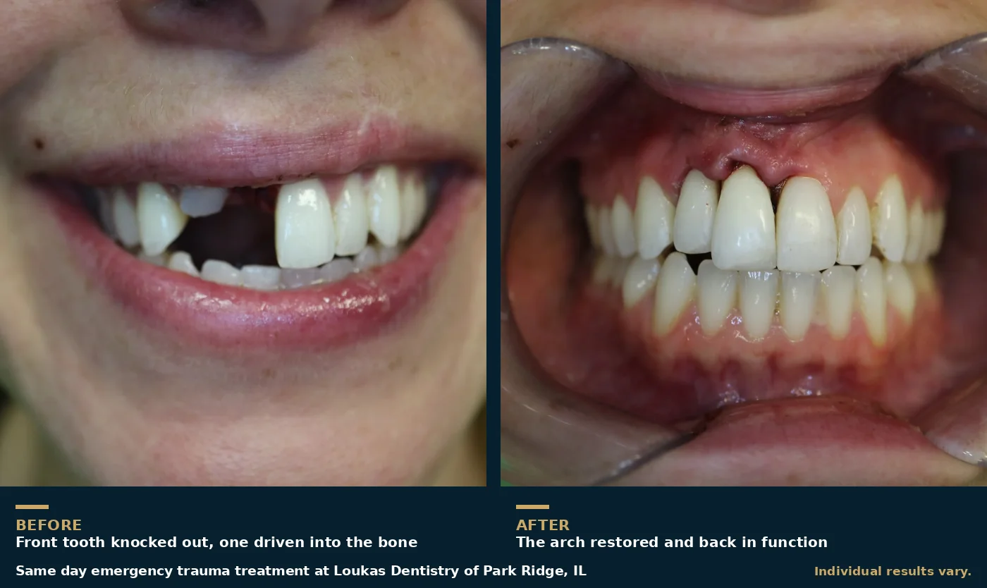 Before and after of same day emergency dental trauma treatment in Park Ridge, IL, showing a knocked out upper front tooth and the restored arch